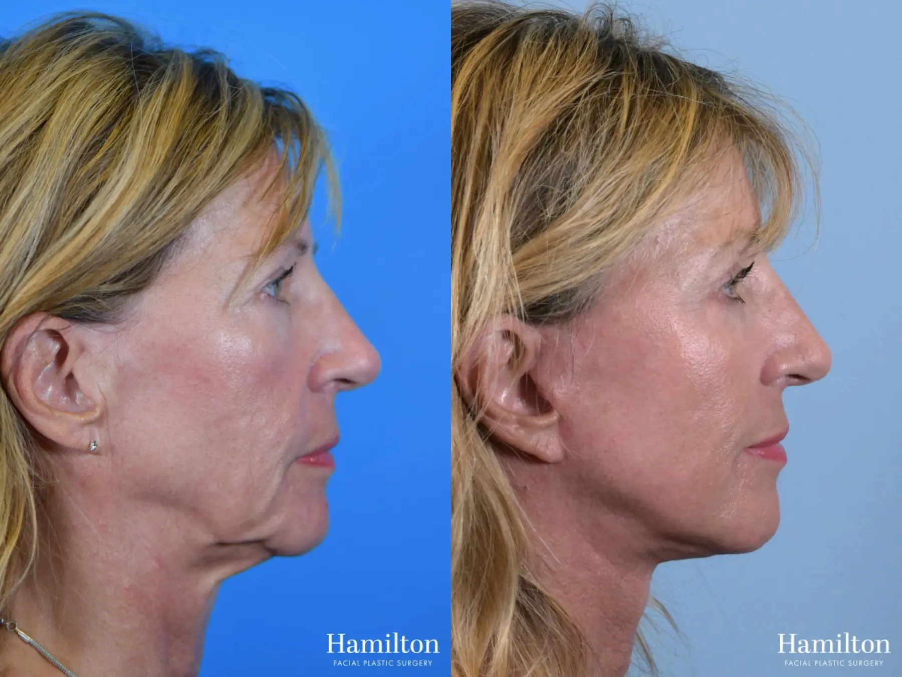 Facelift: Patient 24 - Before and After 2