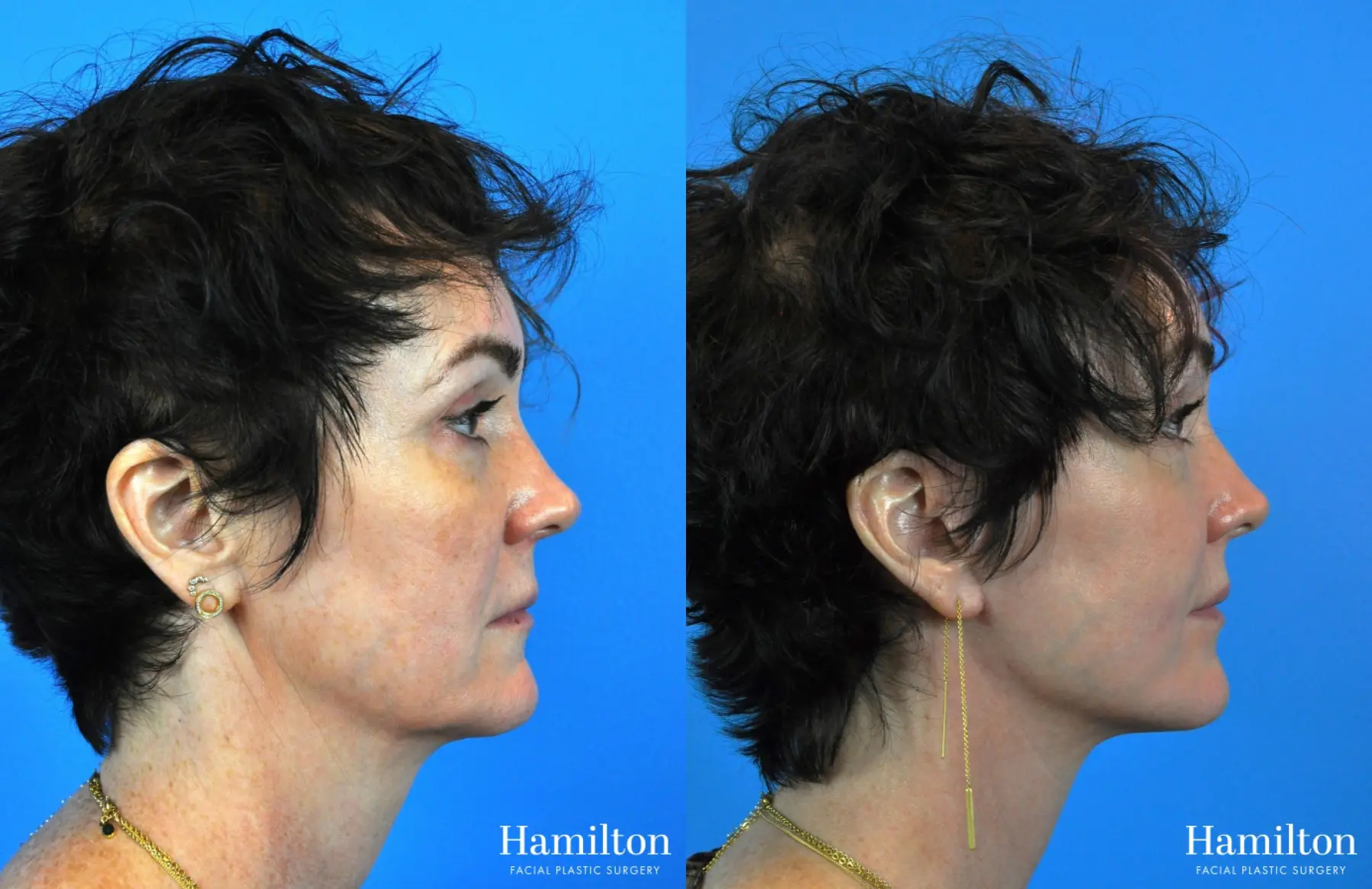 Facelift: Patient 23 - Before and After 2