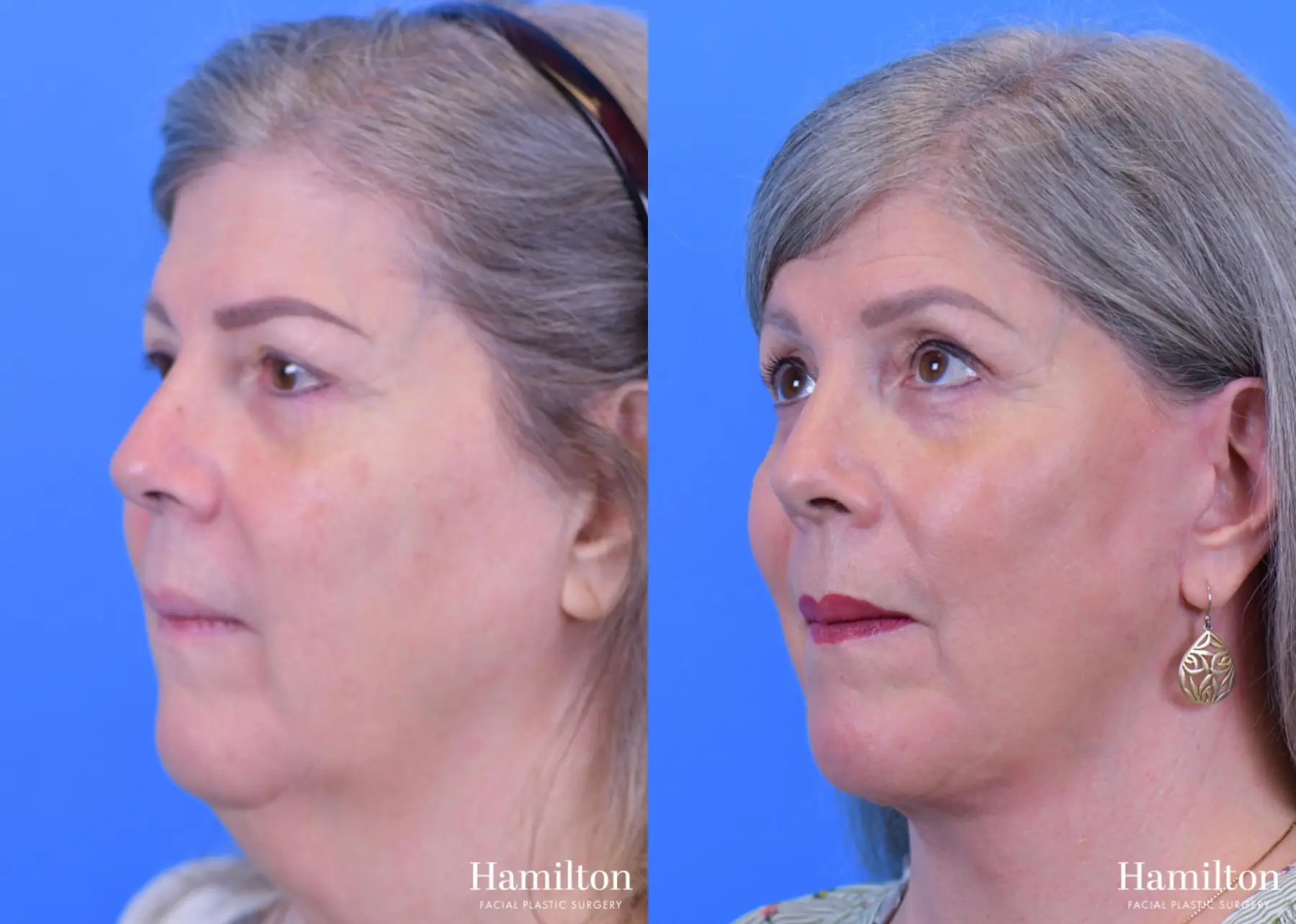 Facelift: Patient 17 - Before and After 4
