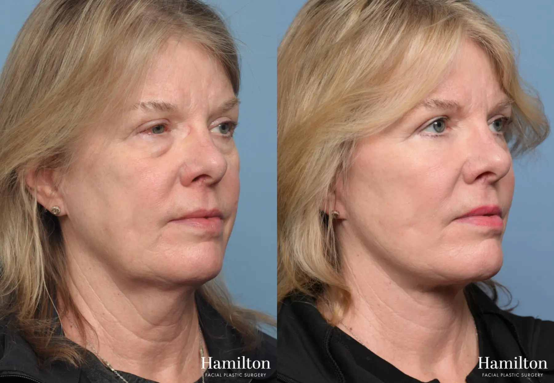 Facelift: Patient 43 - Before and After 1