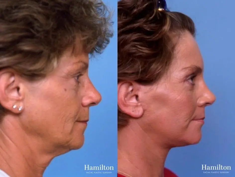 Facelift: Patient 40 - Before and After 3