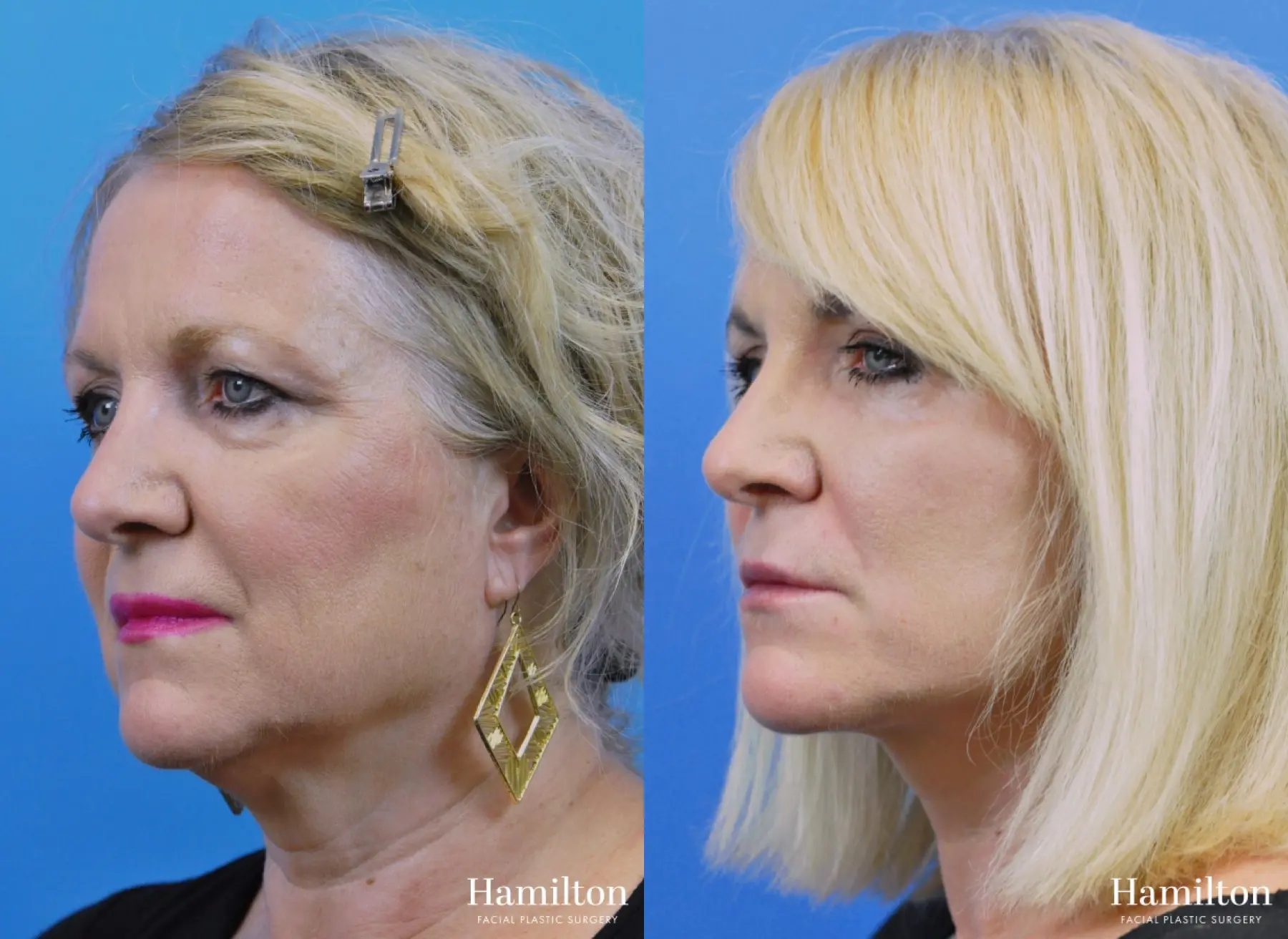 Facelift: Patient 10 - Before and After 2