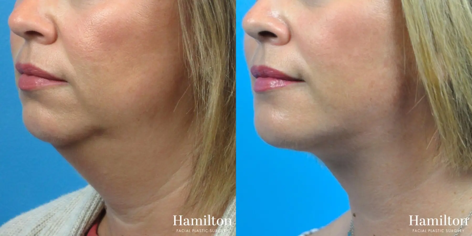 Facelift: Patient 5 - Before and After 3