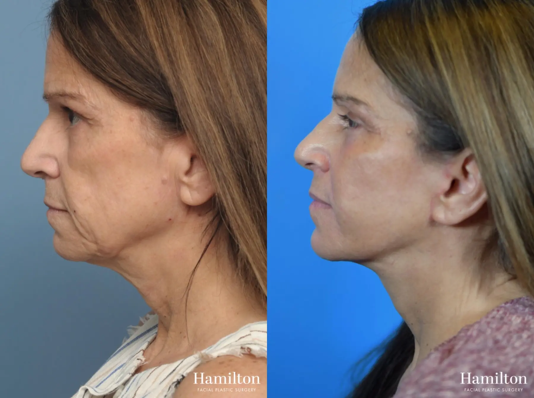 Facelift: Patient 18 - Before and After 2