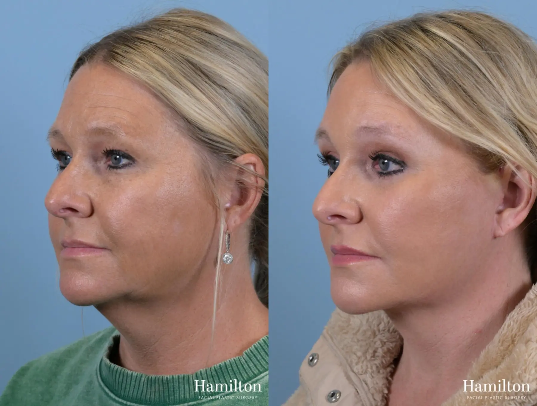 Facelift: Patient 3 - Before and After 2