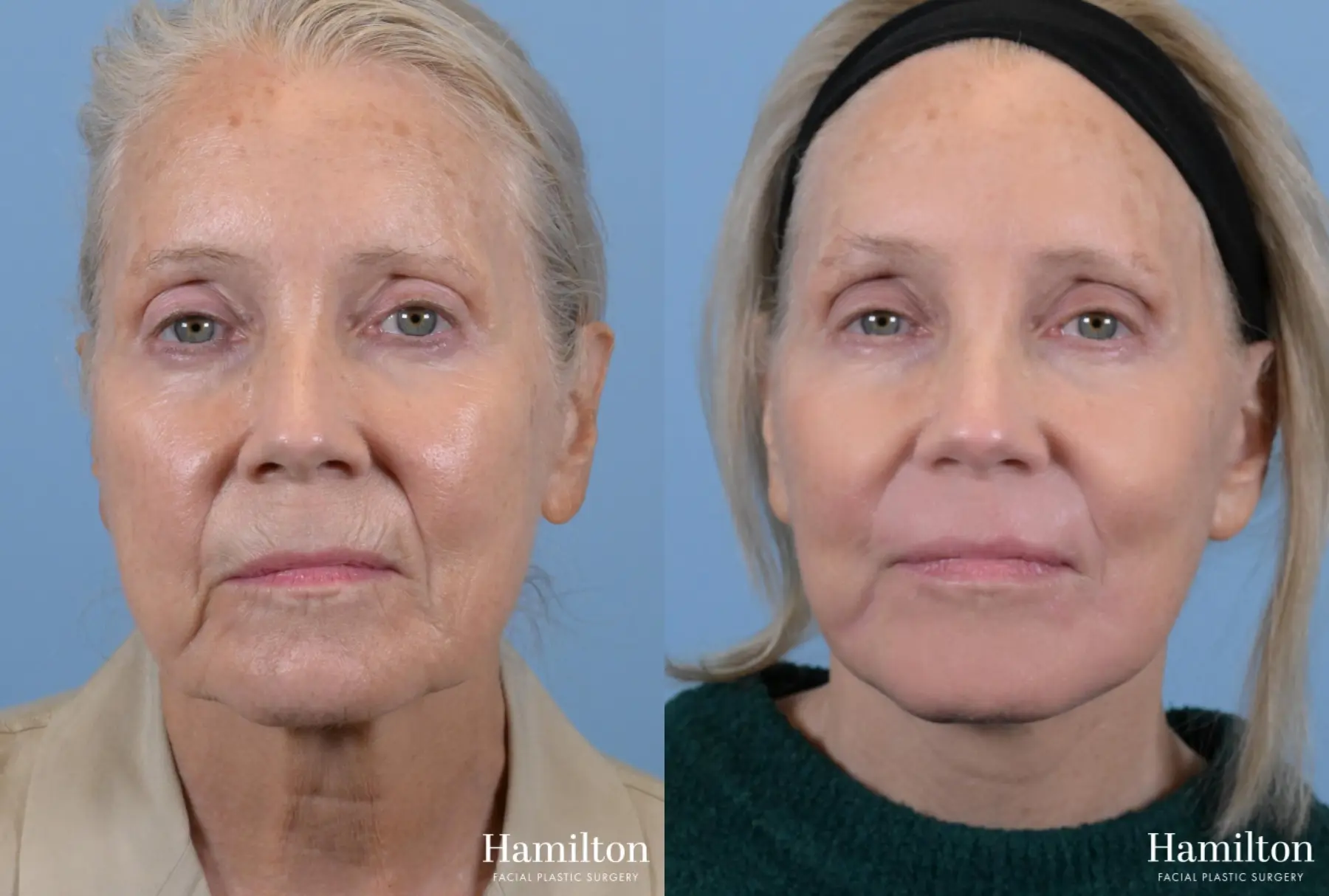 Facelift: Patient 3 - Before and After 5