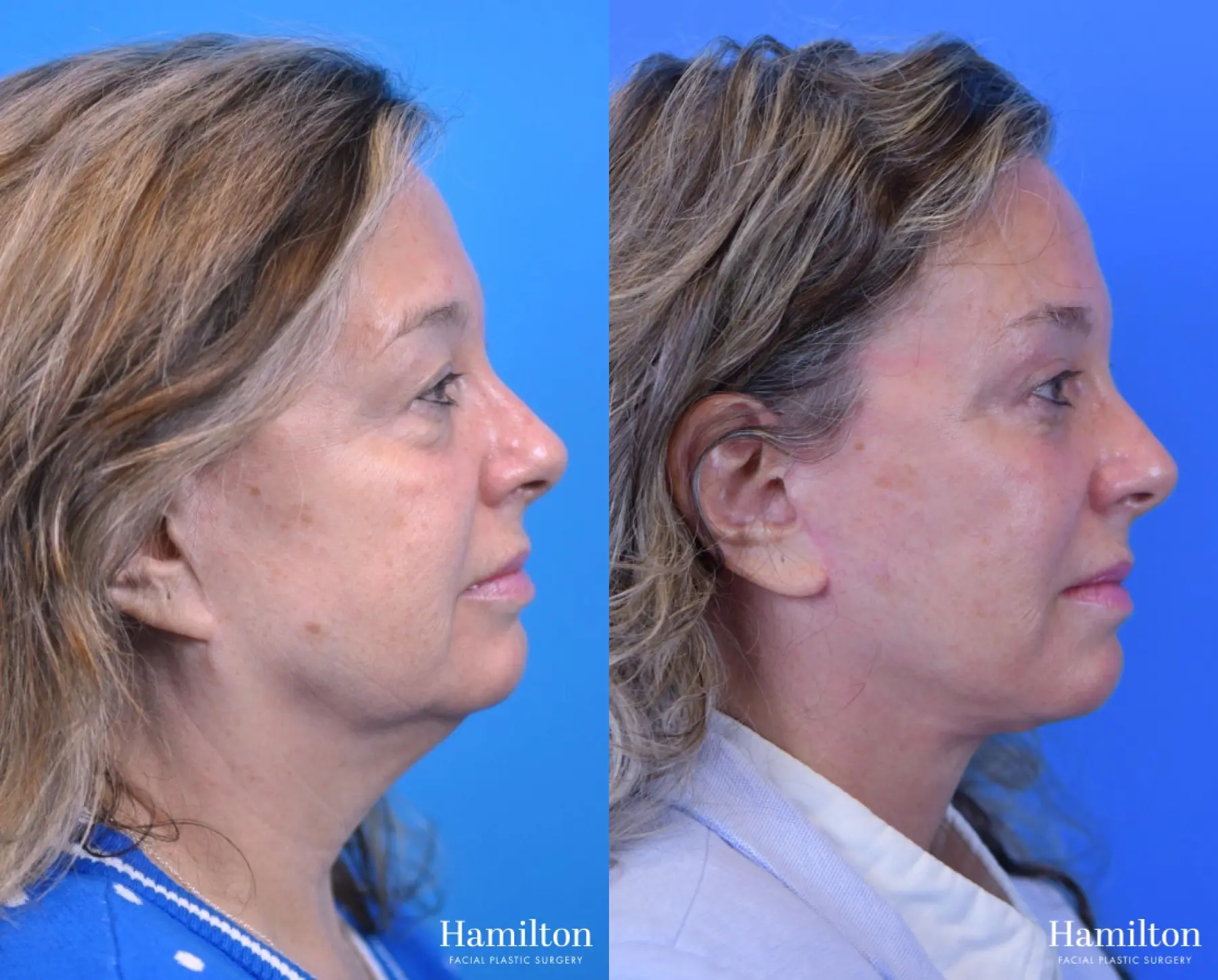 Facelift: Patient 15 - Before and After 1