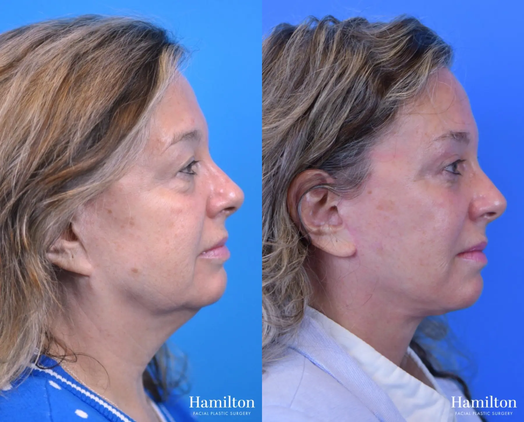 Facelift: Patient 7 - Before and After  