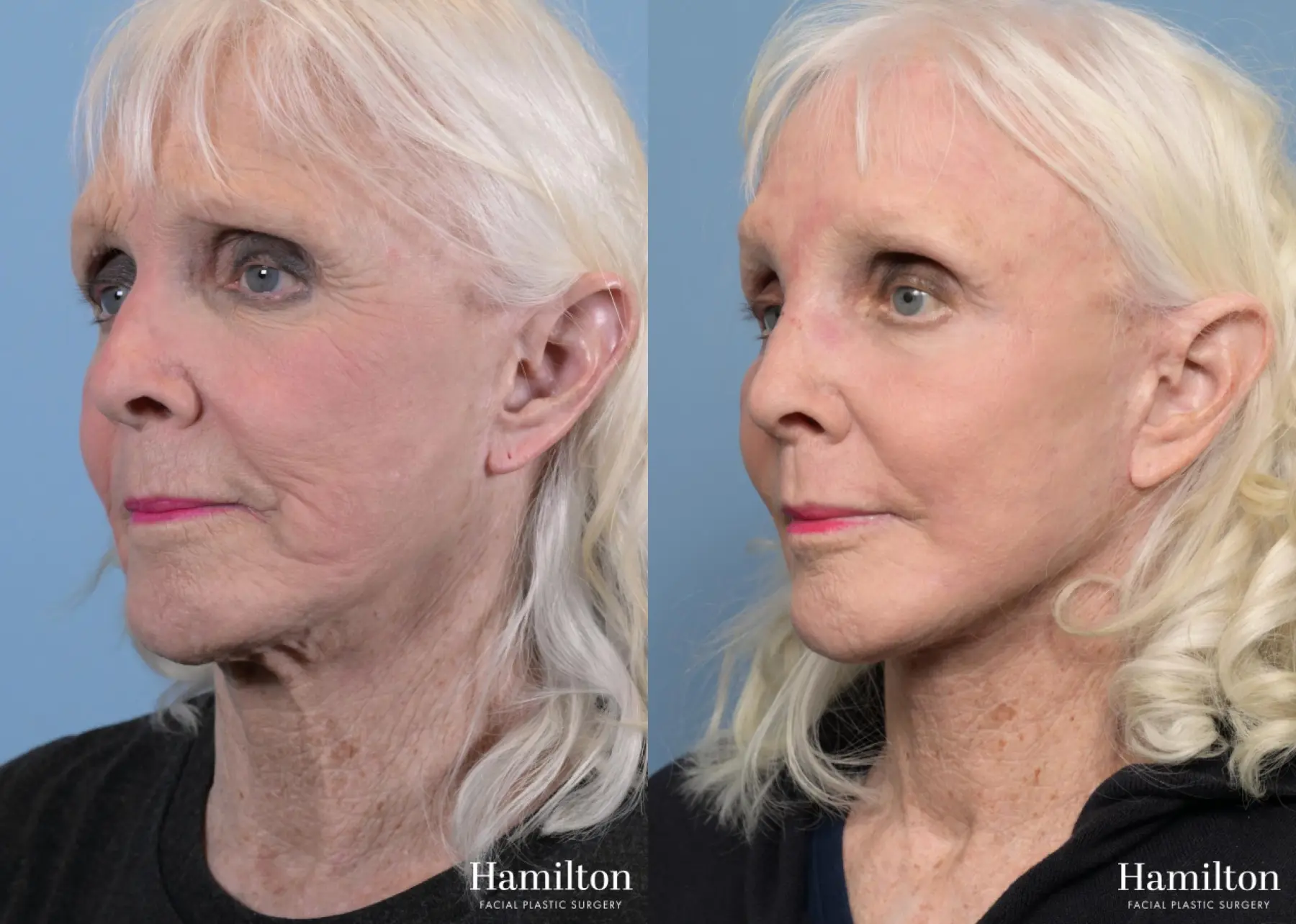 Facelift: Patient 25 - Before and After 1