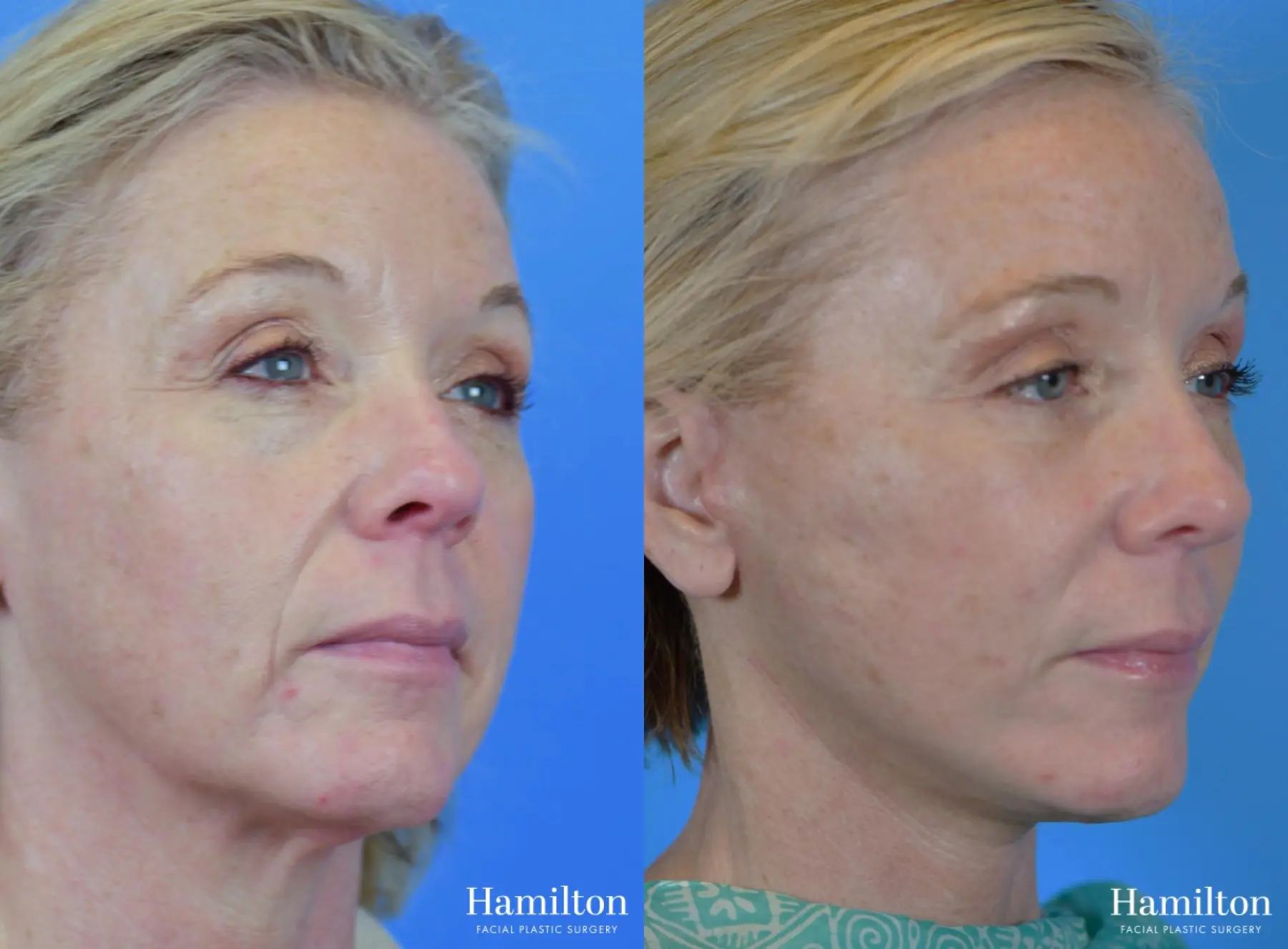 Facelift: Patient 37 - Before and After 4