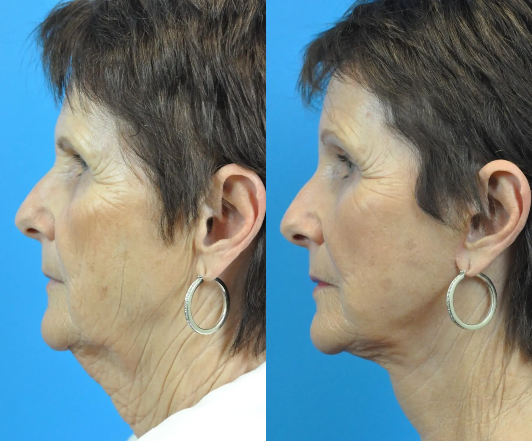 Facelift: Patient 32 - Before and After 1