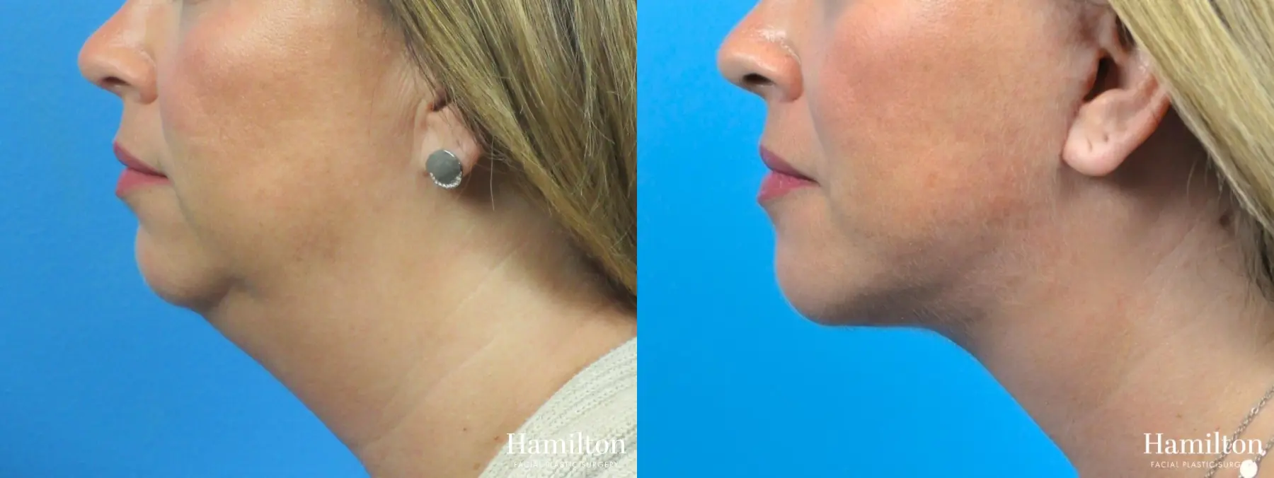 Facelift: Patient 12 - Before and After 1