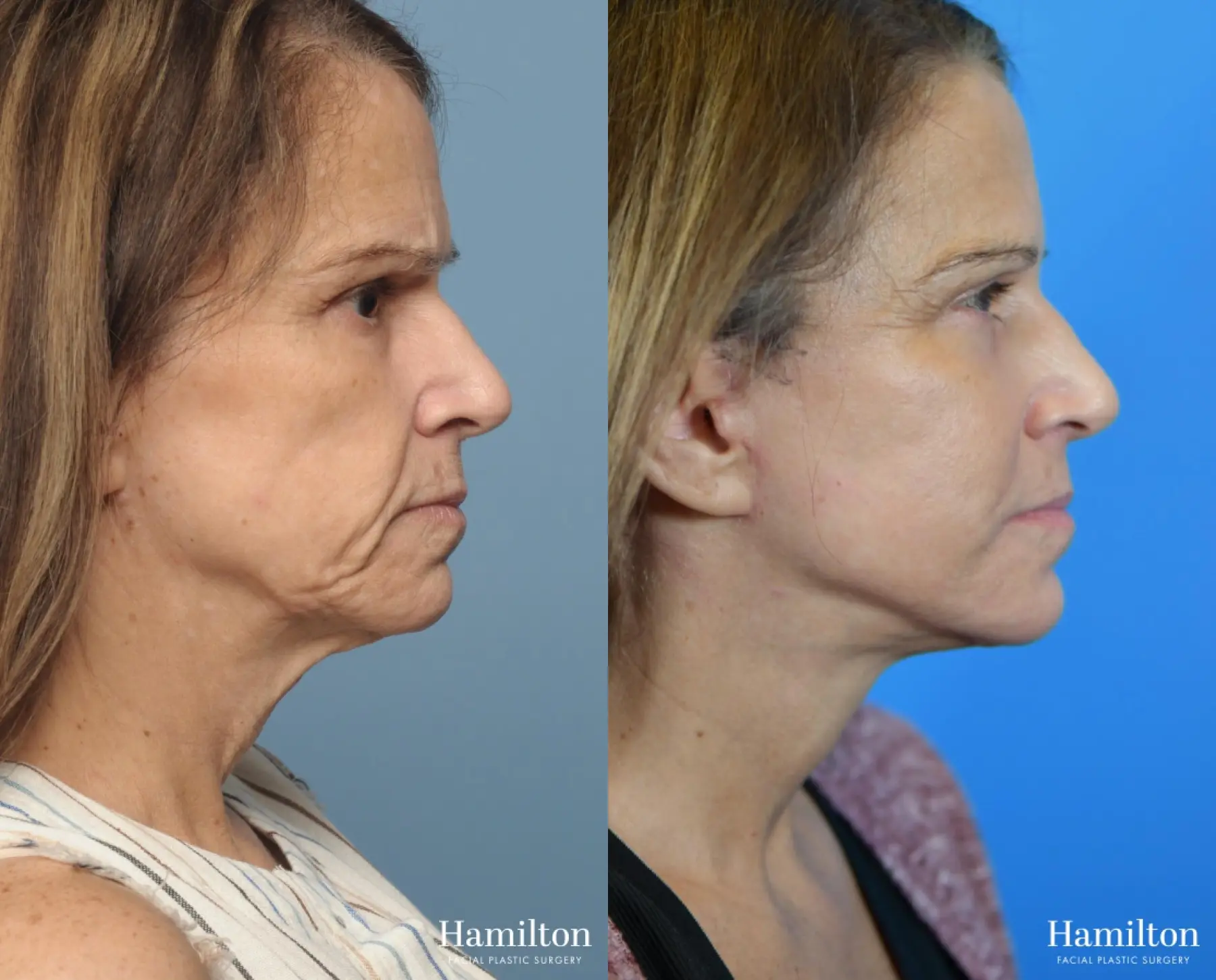 Facelift: Patient 9 - Before and After  