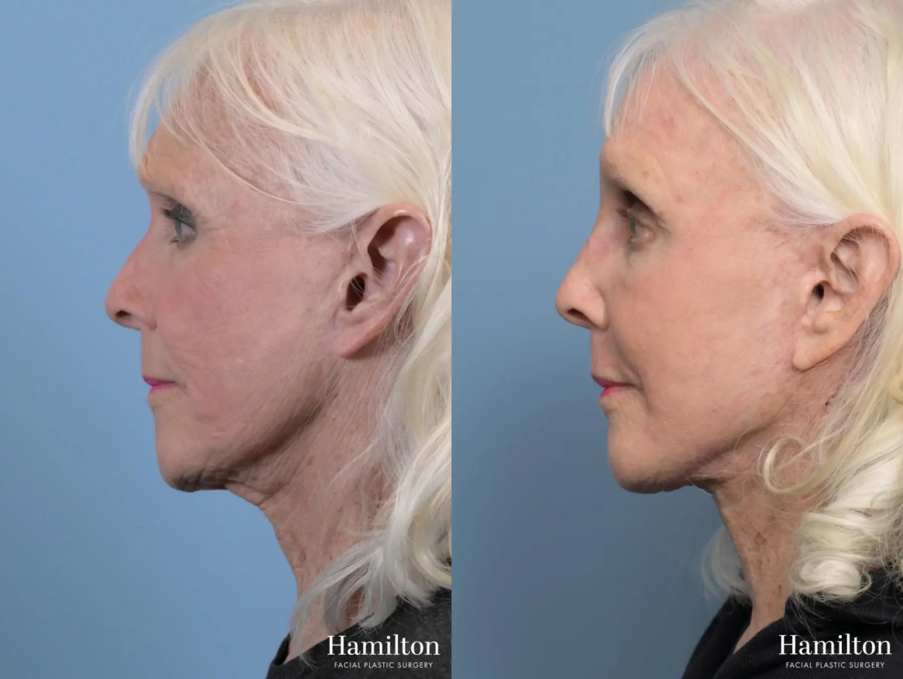 Facelift: Patient 25 - Before and After 2
