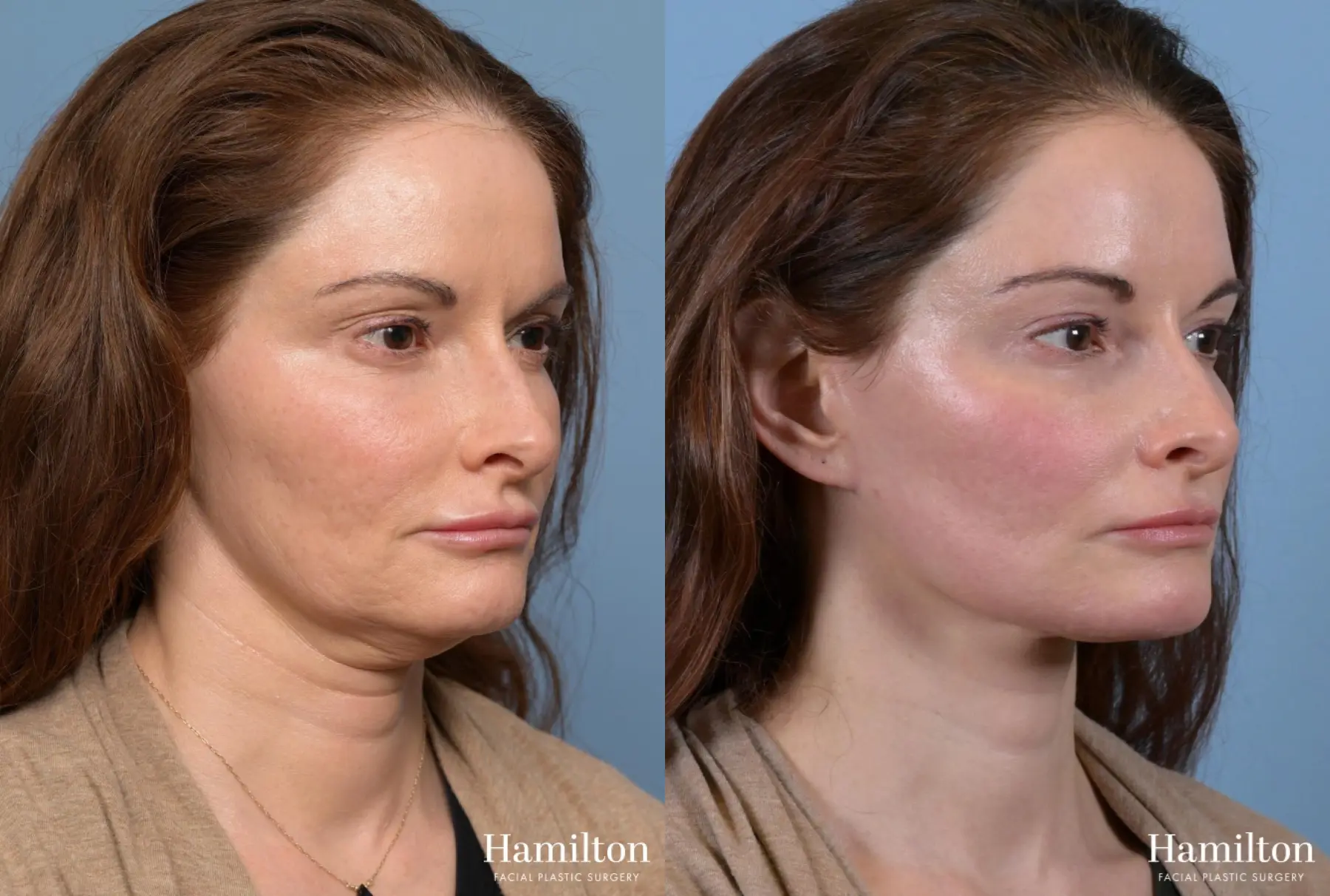 Facelift: Patient 1 - Before and After 2