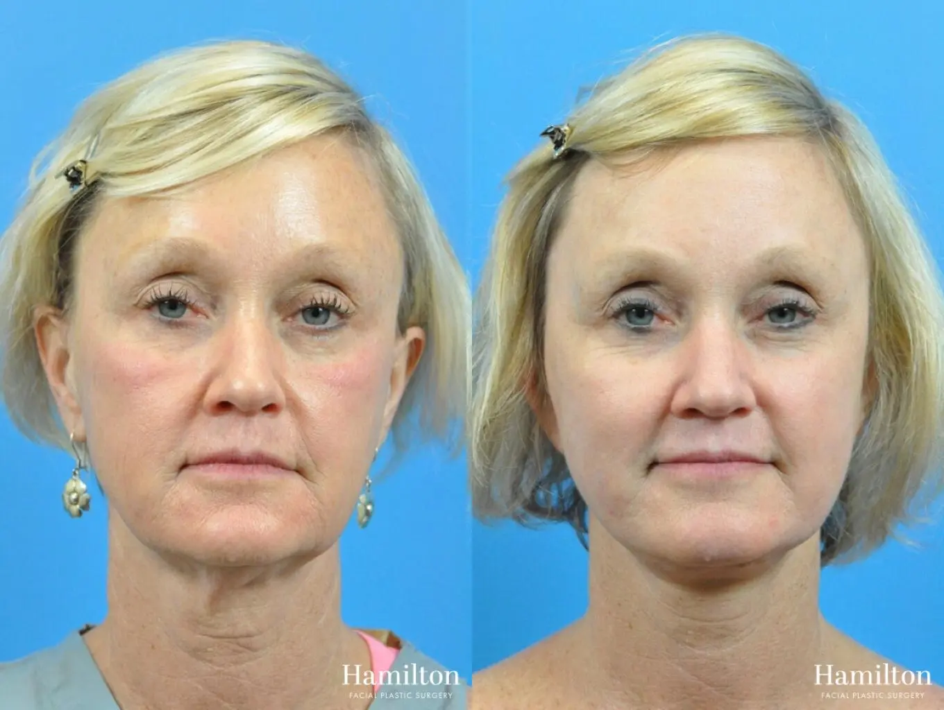 Facelift: Patient 38 - Before and After 1