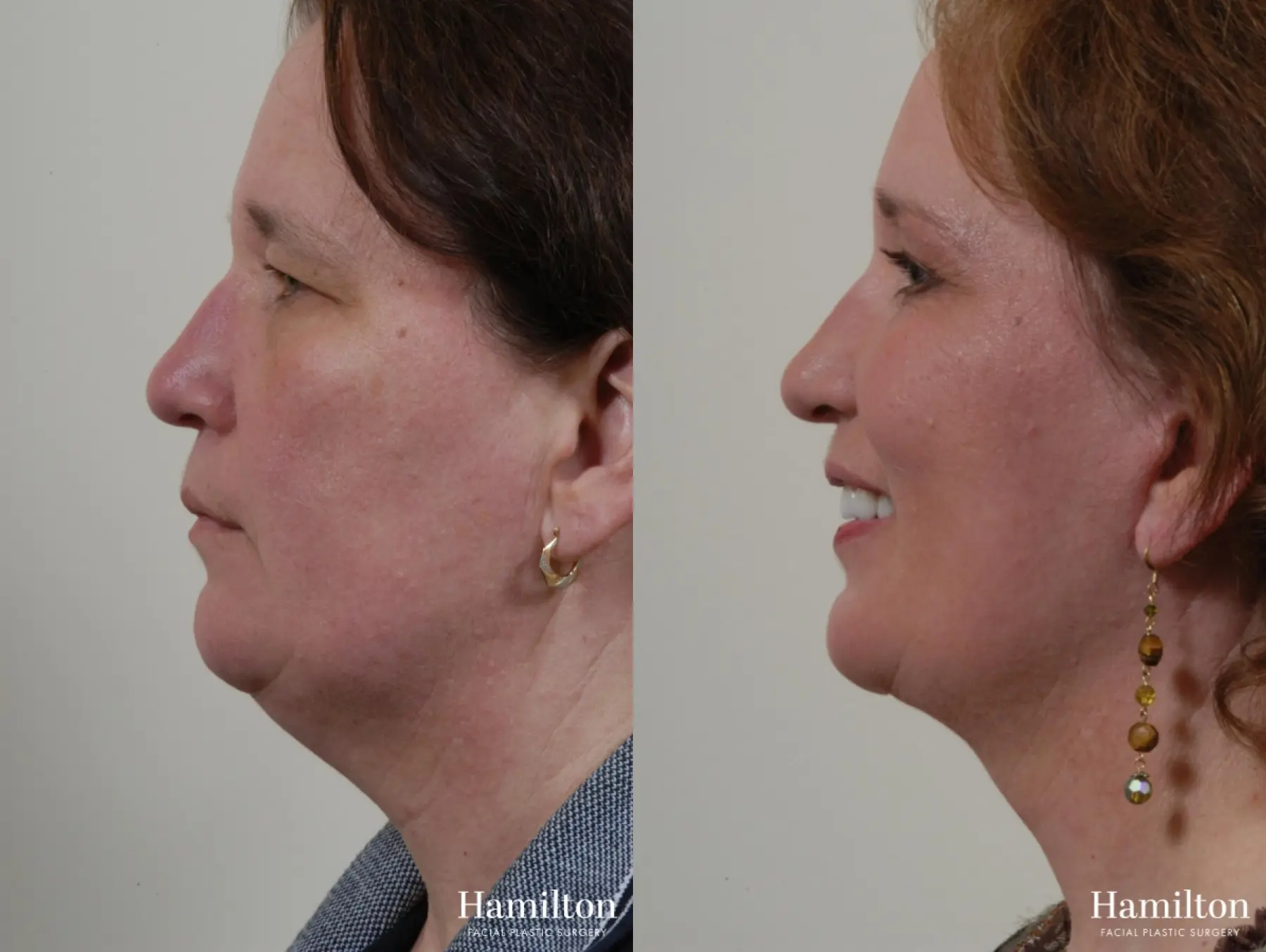 Facelift: Patient 4 - Before and After  