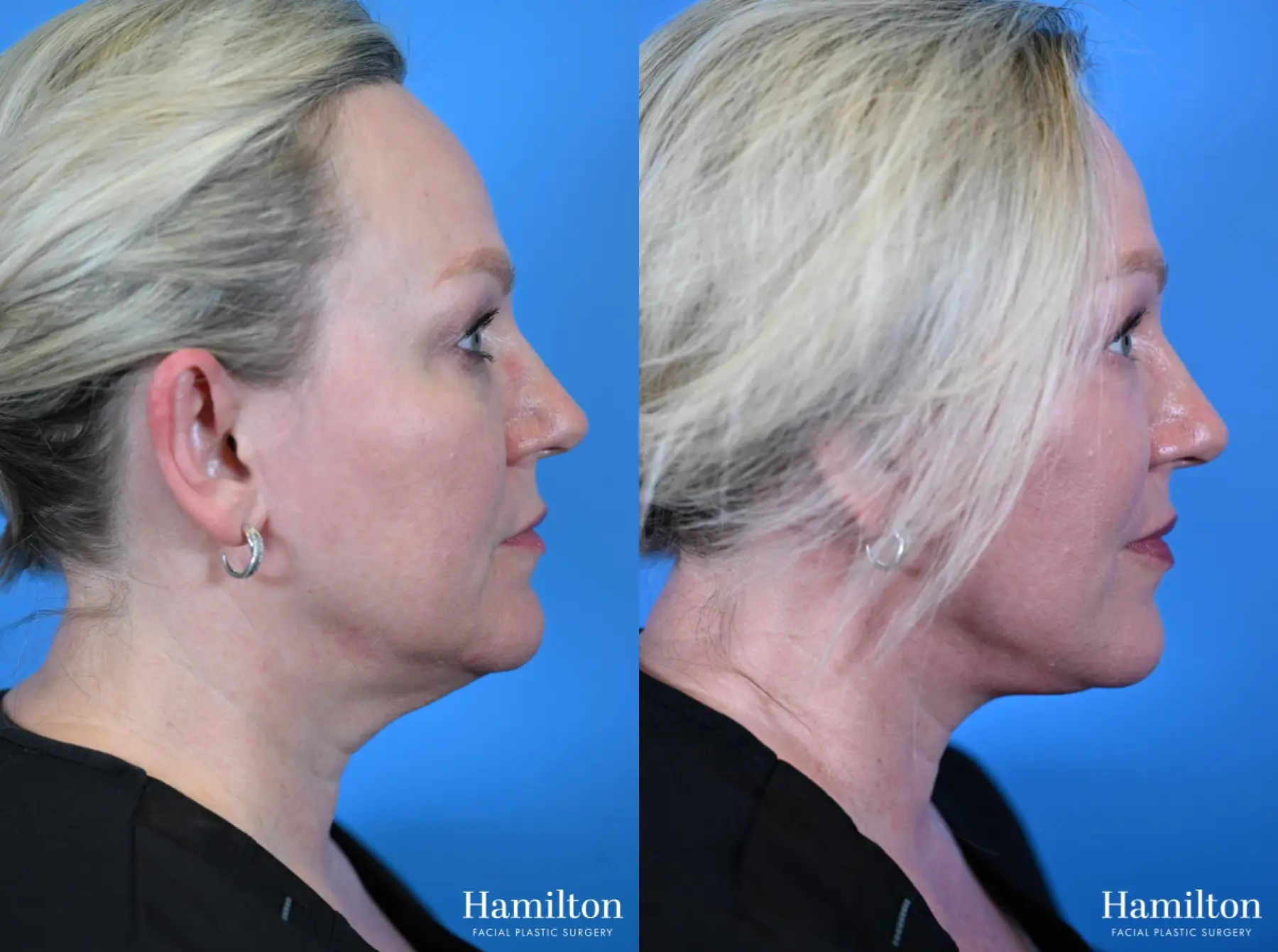 Facelift: Patient 36 - Before and After 4