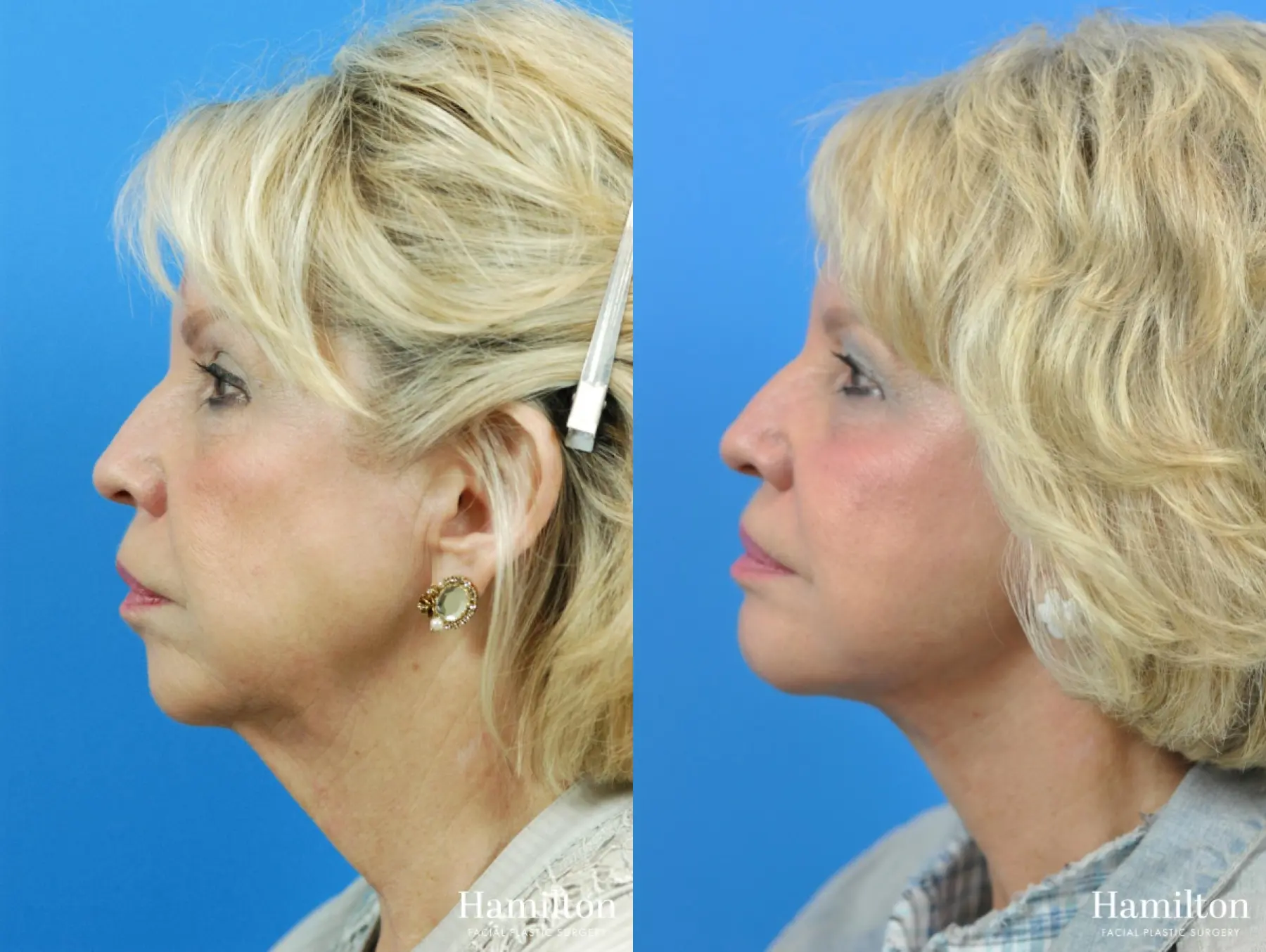 Facelift: Patient 20 - Before and After 3