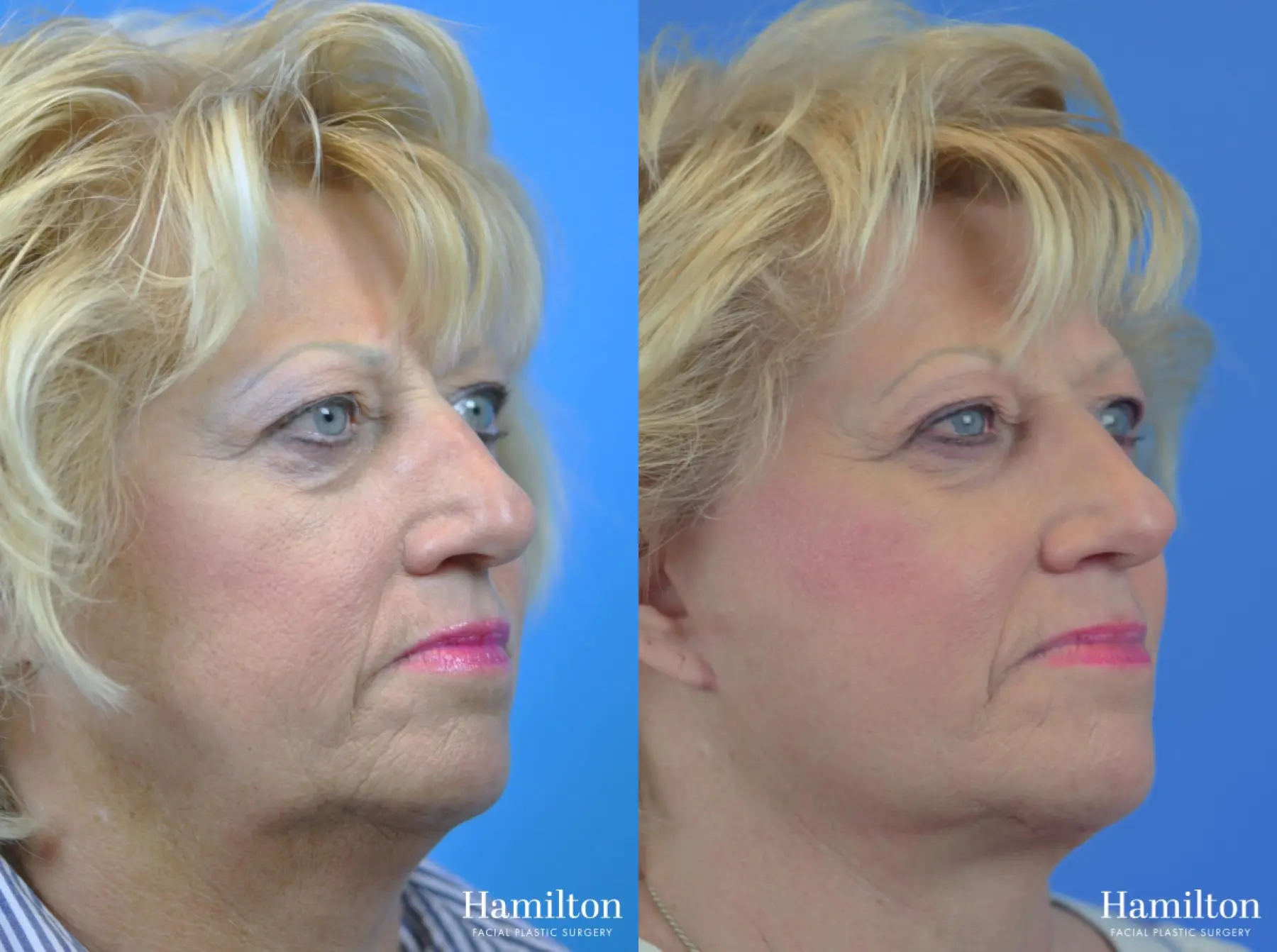 Facelift: Patient 23 - Before and After 4
