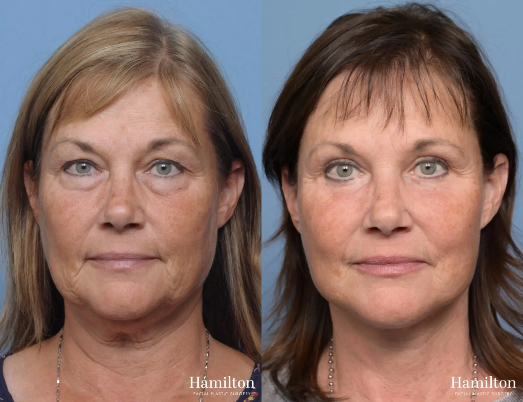 Facelift: Patient 14 - Before and After 5