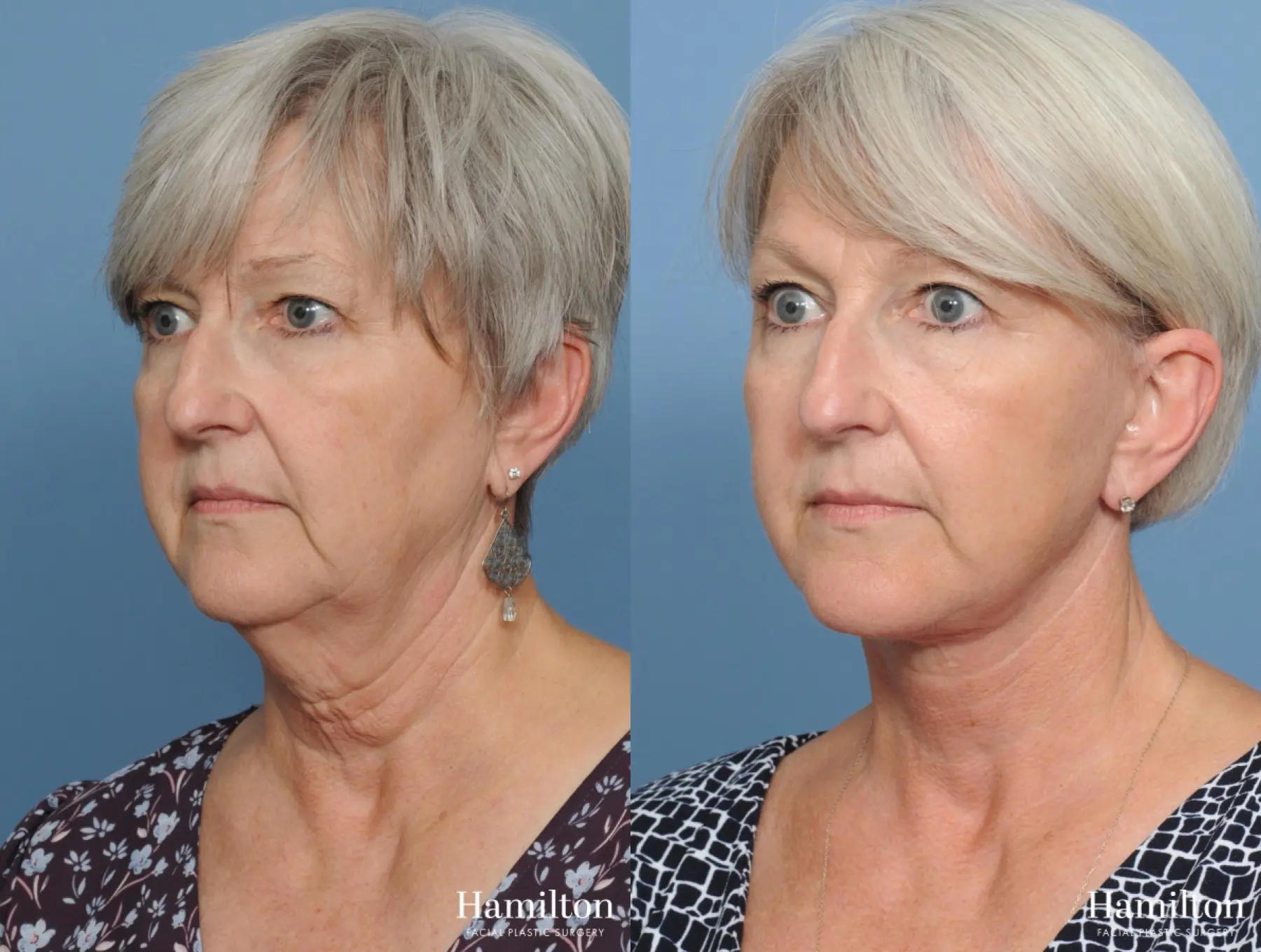 Facelift: Patient 4 - Before and After 3