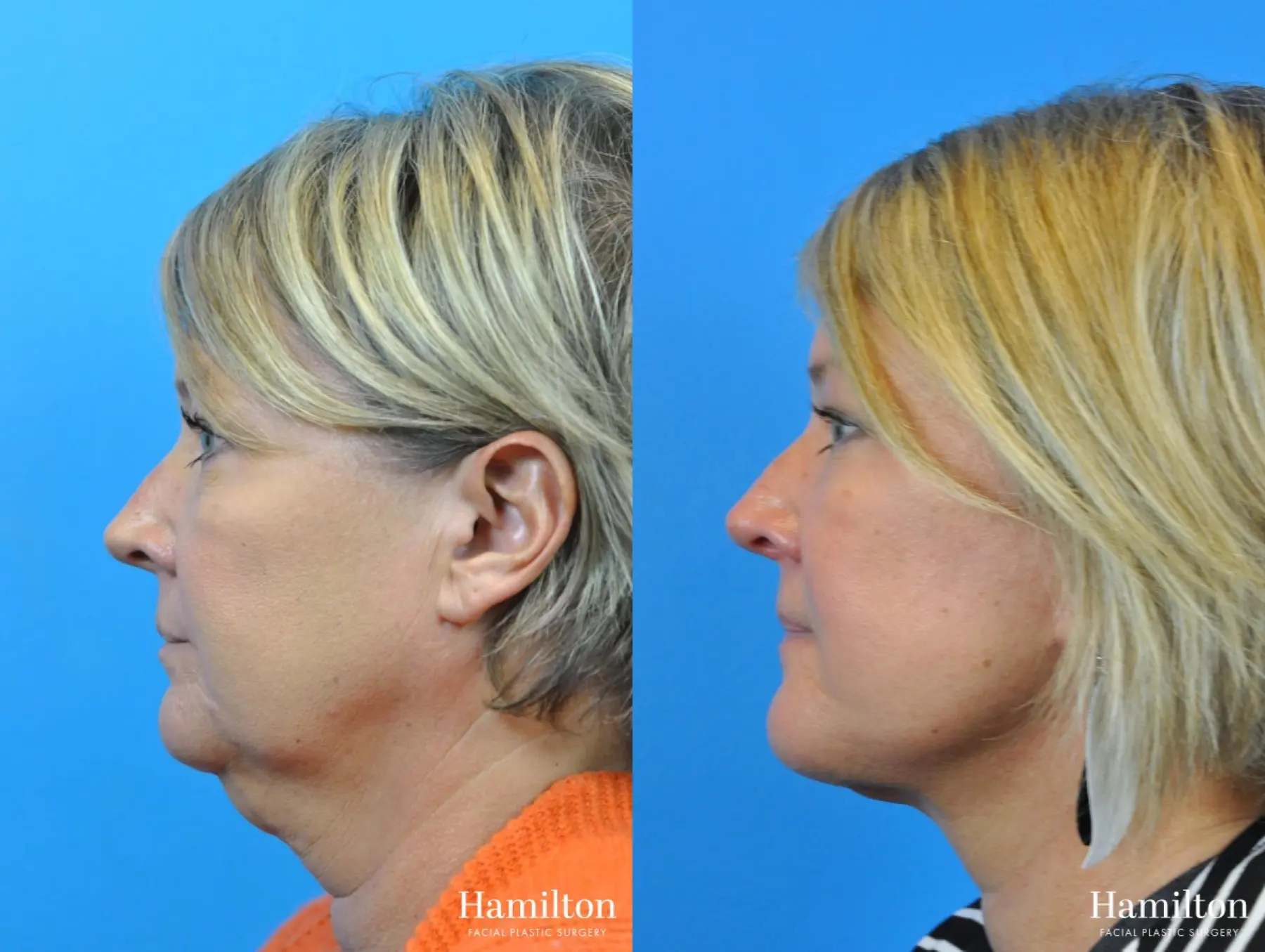 Facelift: Patient 7 - Before and After 1