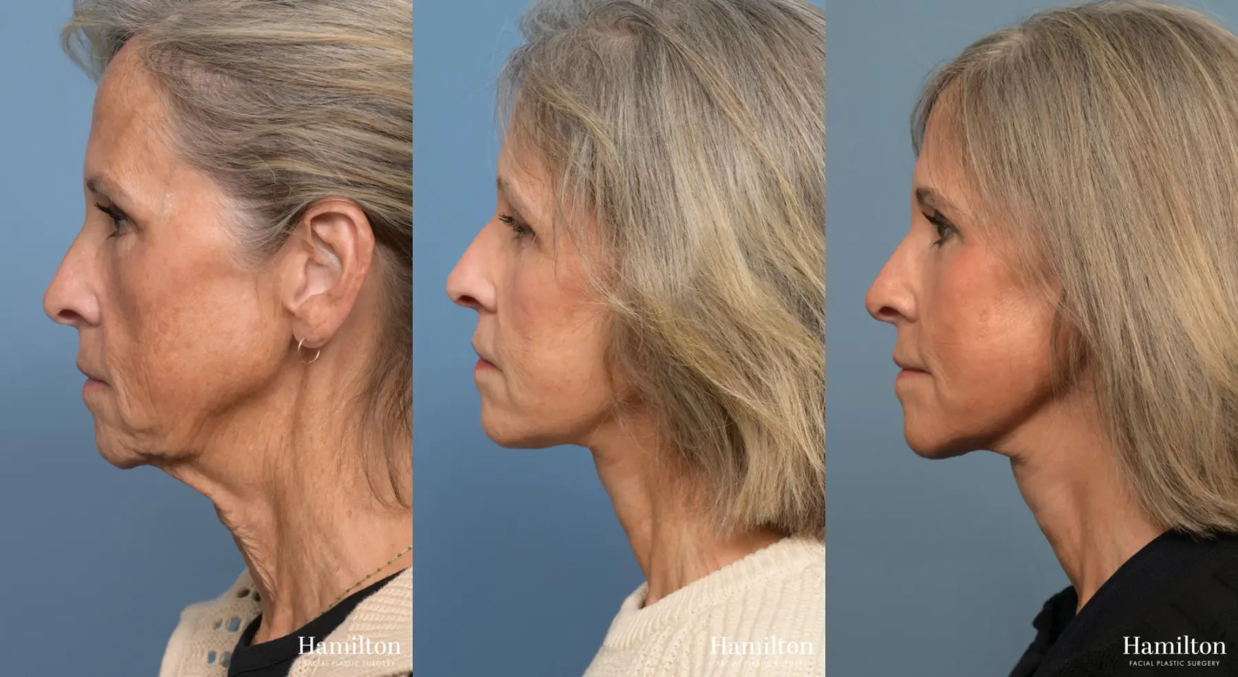 Facelift: Patient 8 - Before and After 5