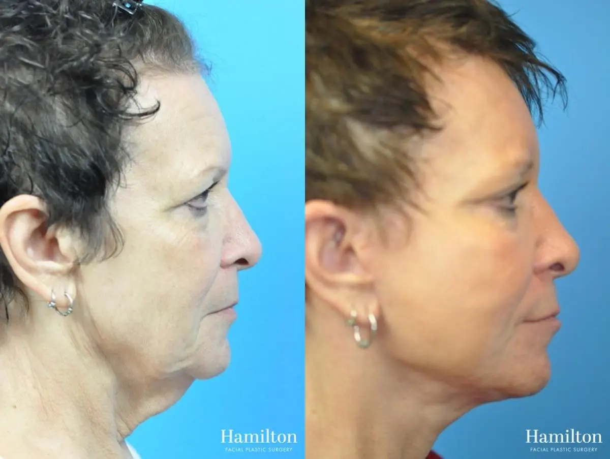 Facelift: Patient 28 - Before and After 3