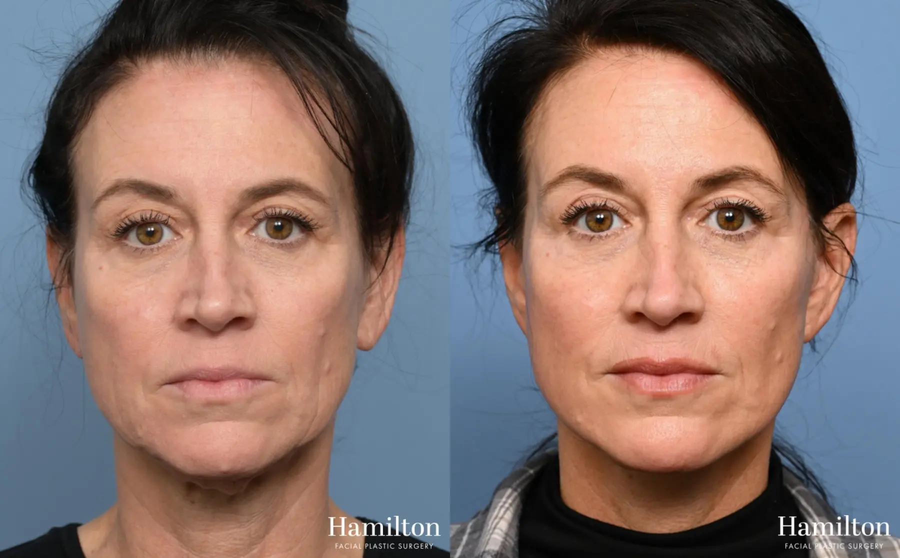 Facelift: Patient 29 - Before and After 4