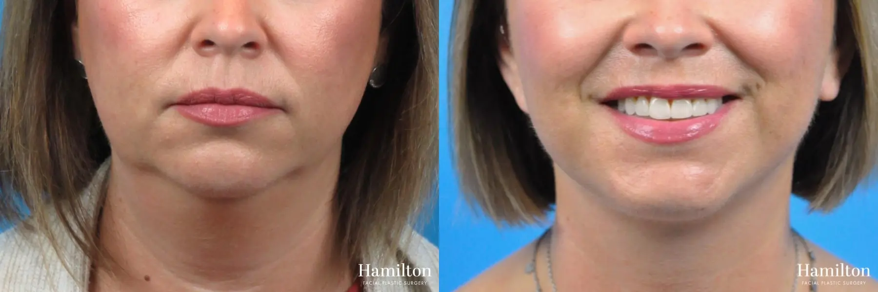 Facelift: Patient 5 - Before and After 2