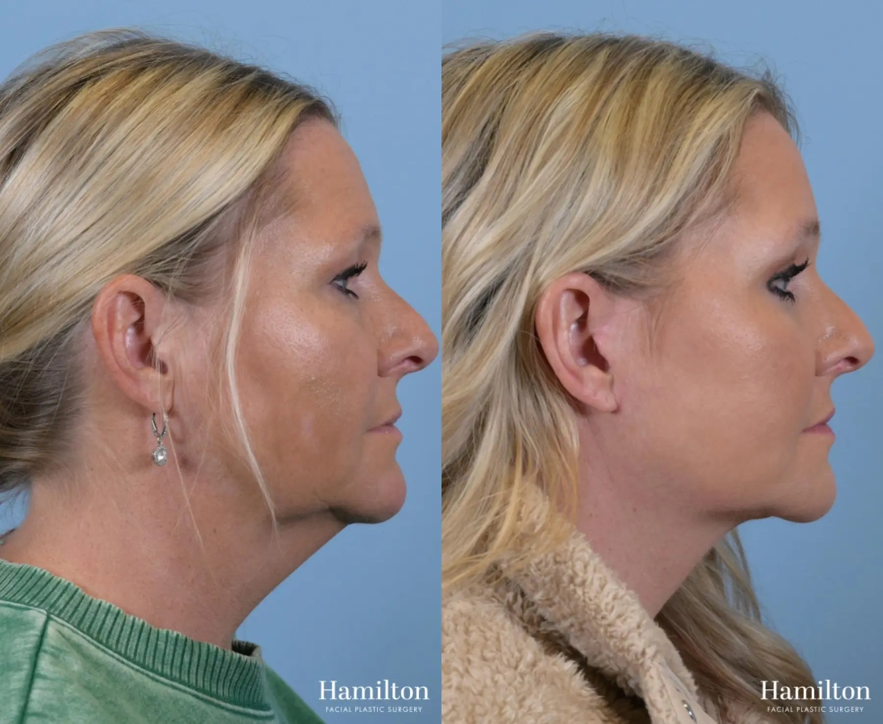 Facelift: Patient 3 - Before and After 3