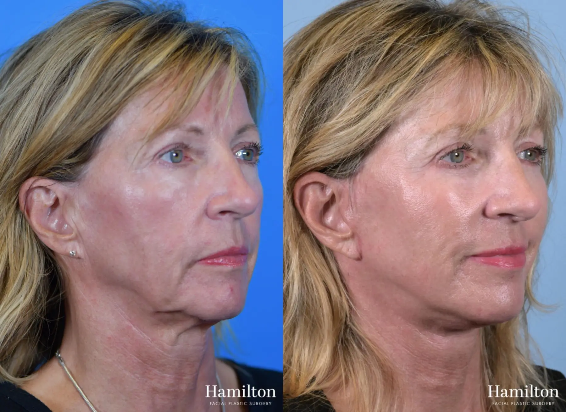 Facelift: Patient 24 - Before and After 3