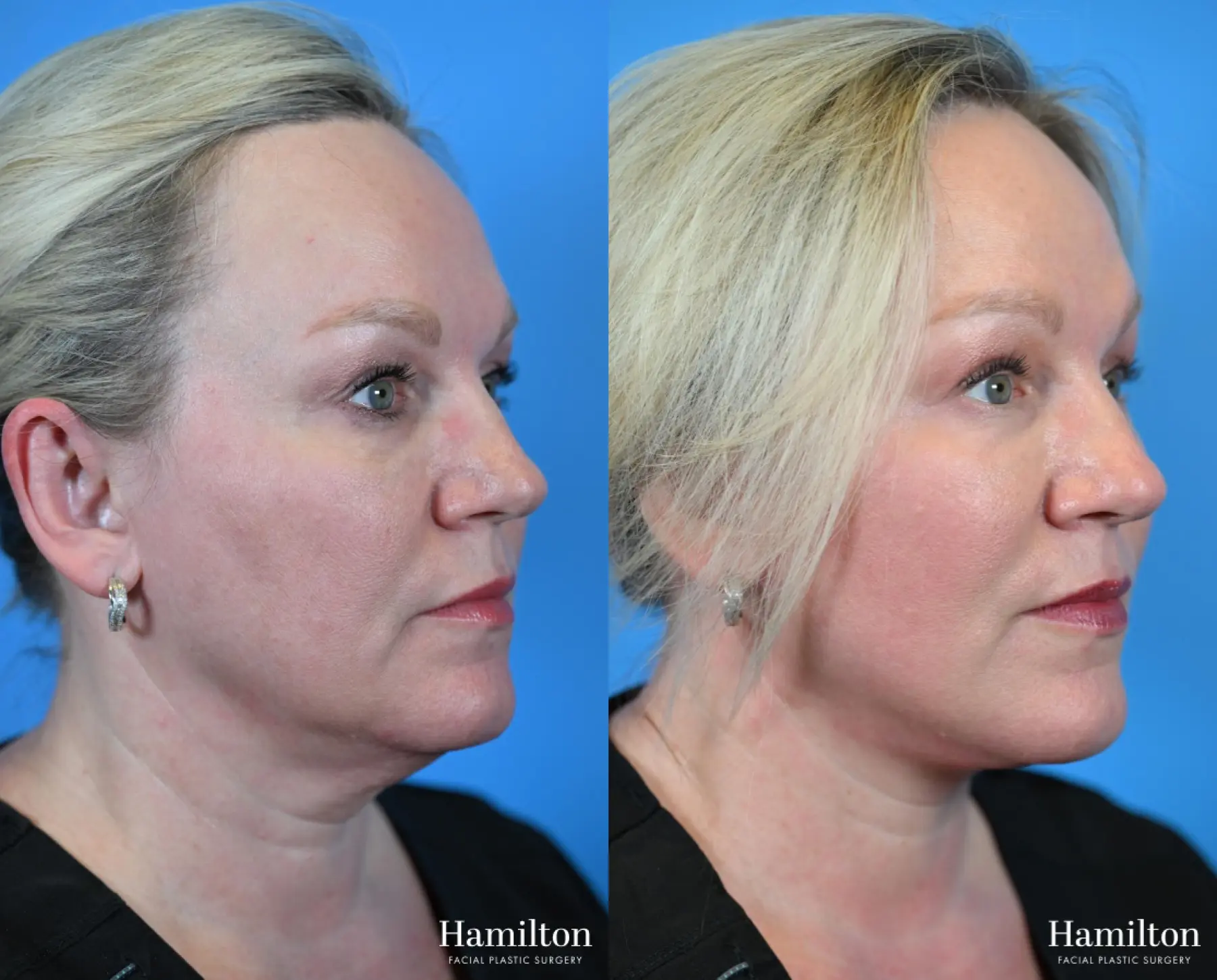 Facelift: Patient 36 - Before and After 2
