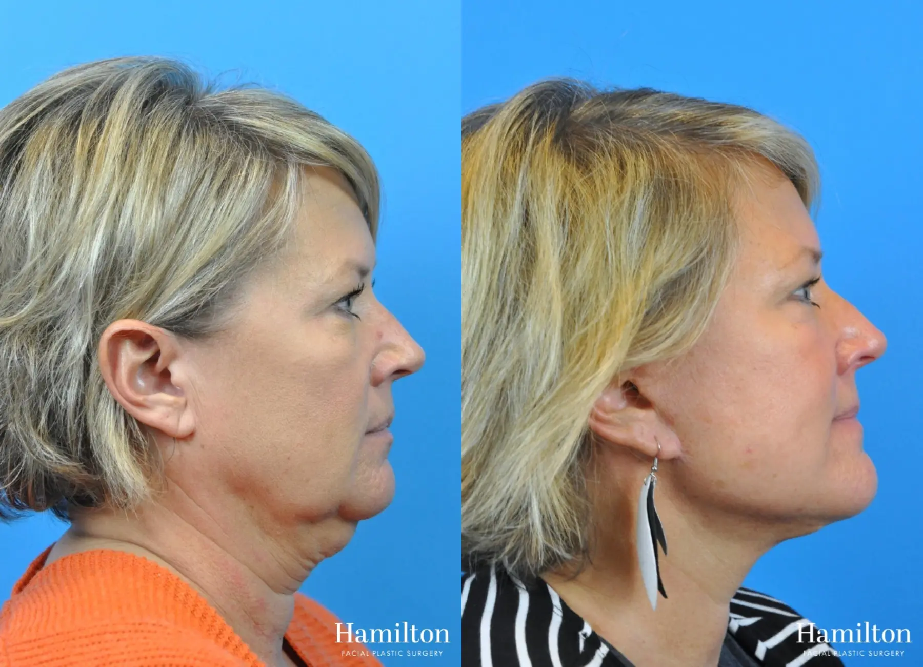 Facelift: Patient 7 - Before and After 2