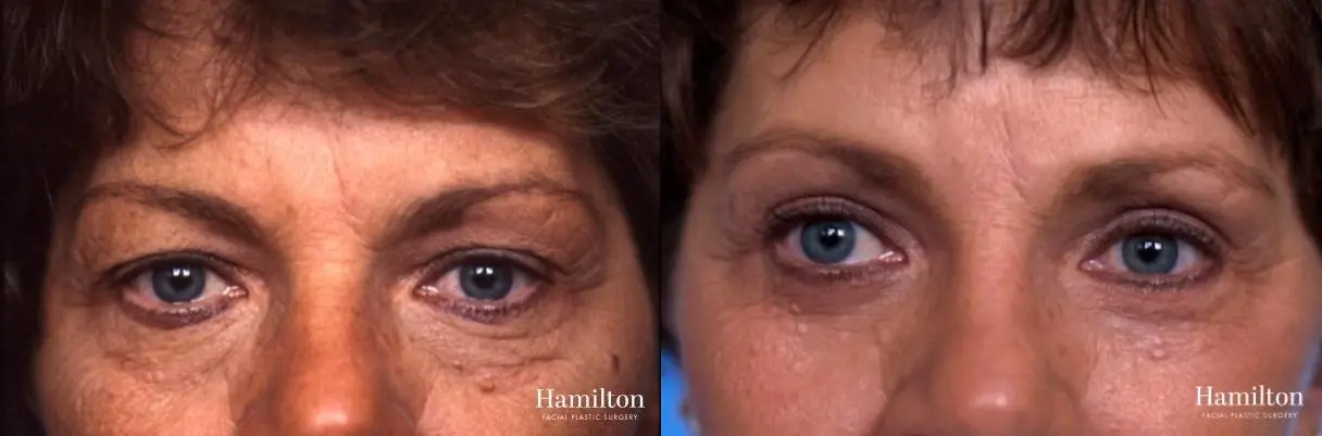 Facelift: Patient 40 - Before and After 4