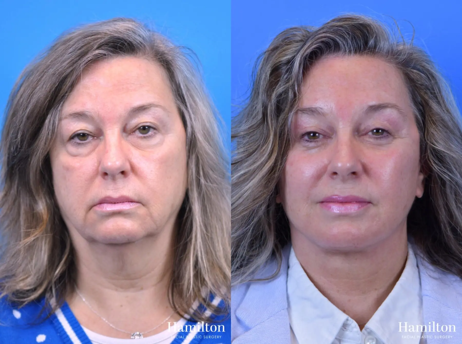 Facelift: Patient 15 - Before and After 3