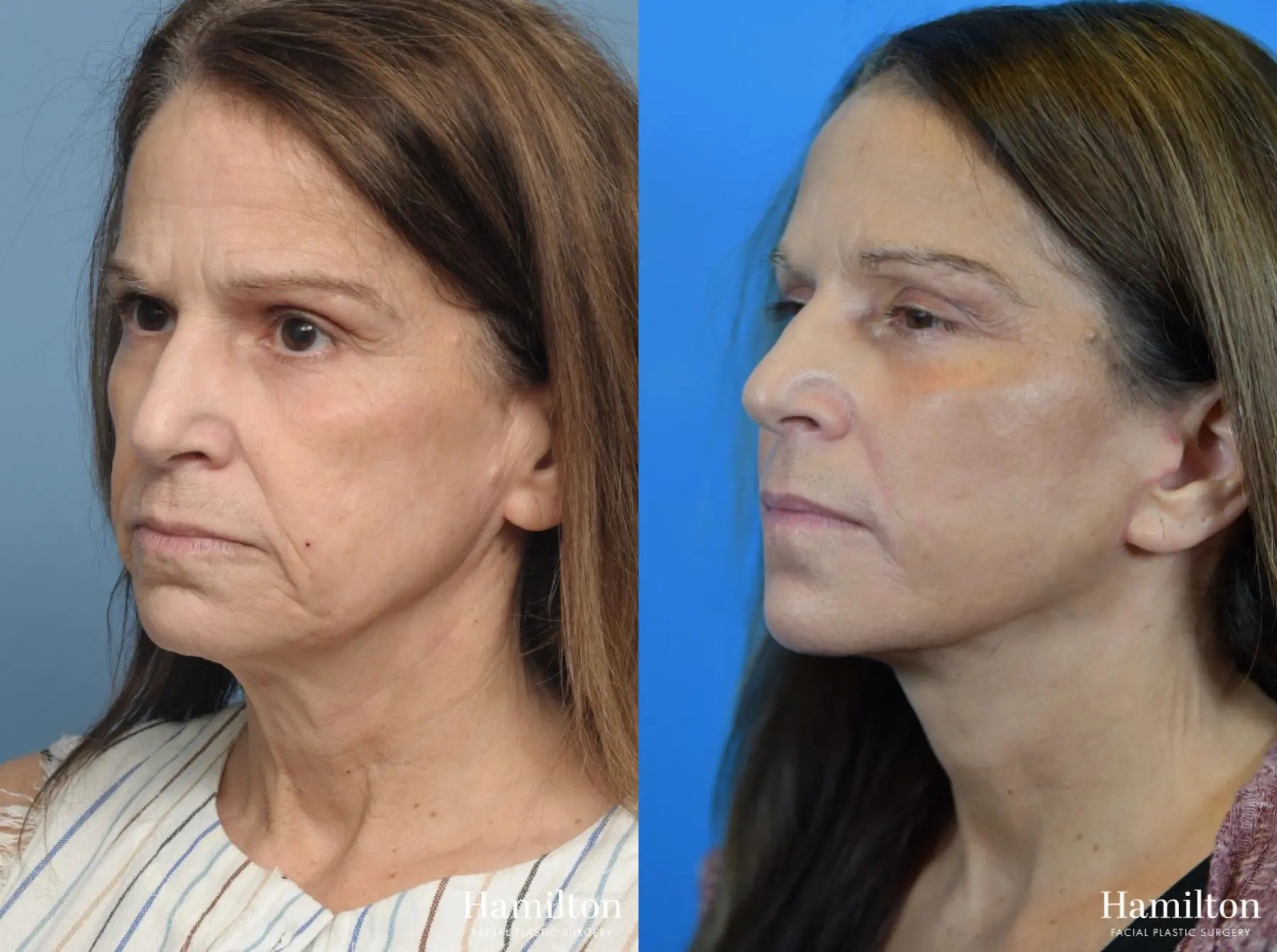 Facelift: Patient 18 - Before and After 3