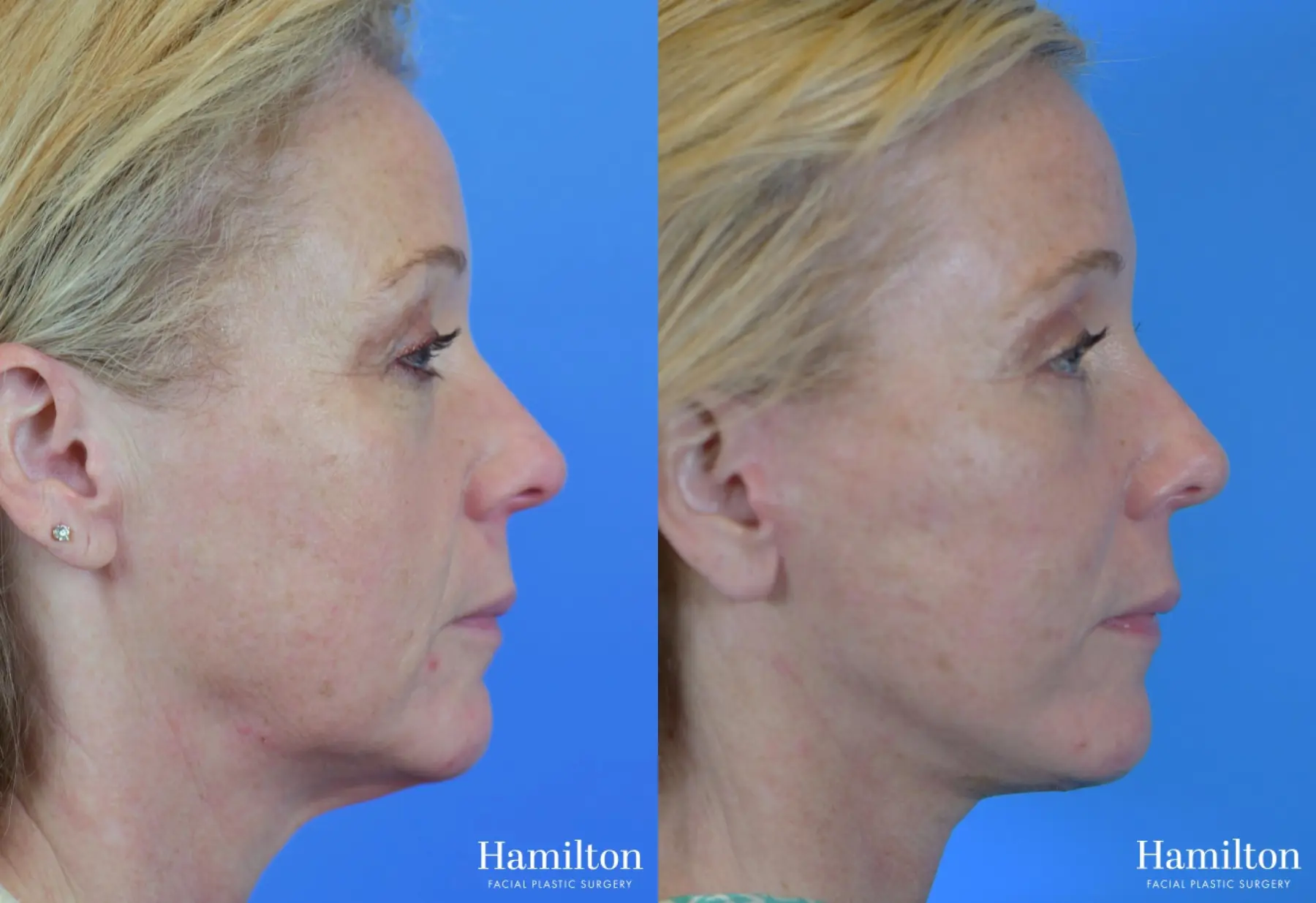 Facelift: Patient 37 - Before and After 2