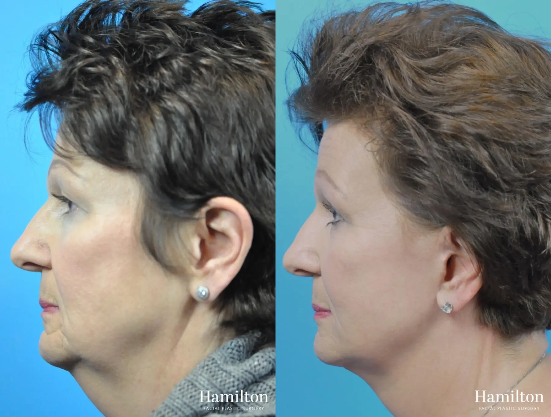 Facelift: Patient 36 - Before and After 1