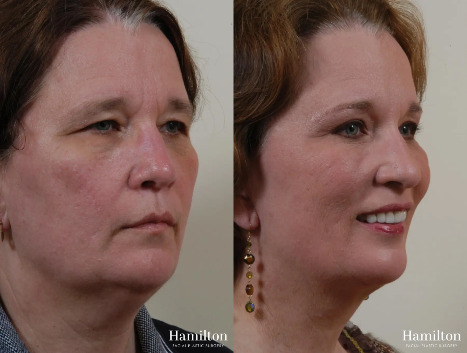 Facelift: Patient 6 - Before and After 4