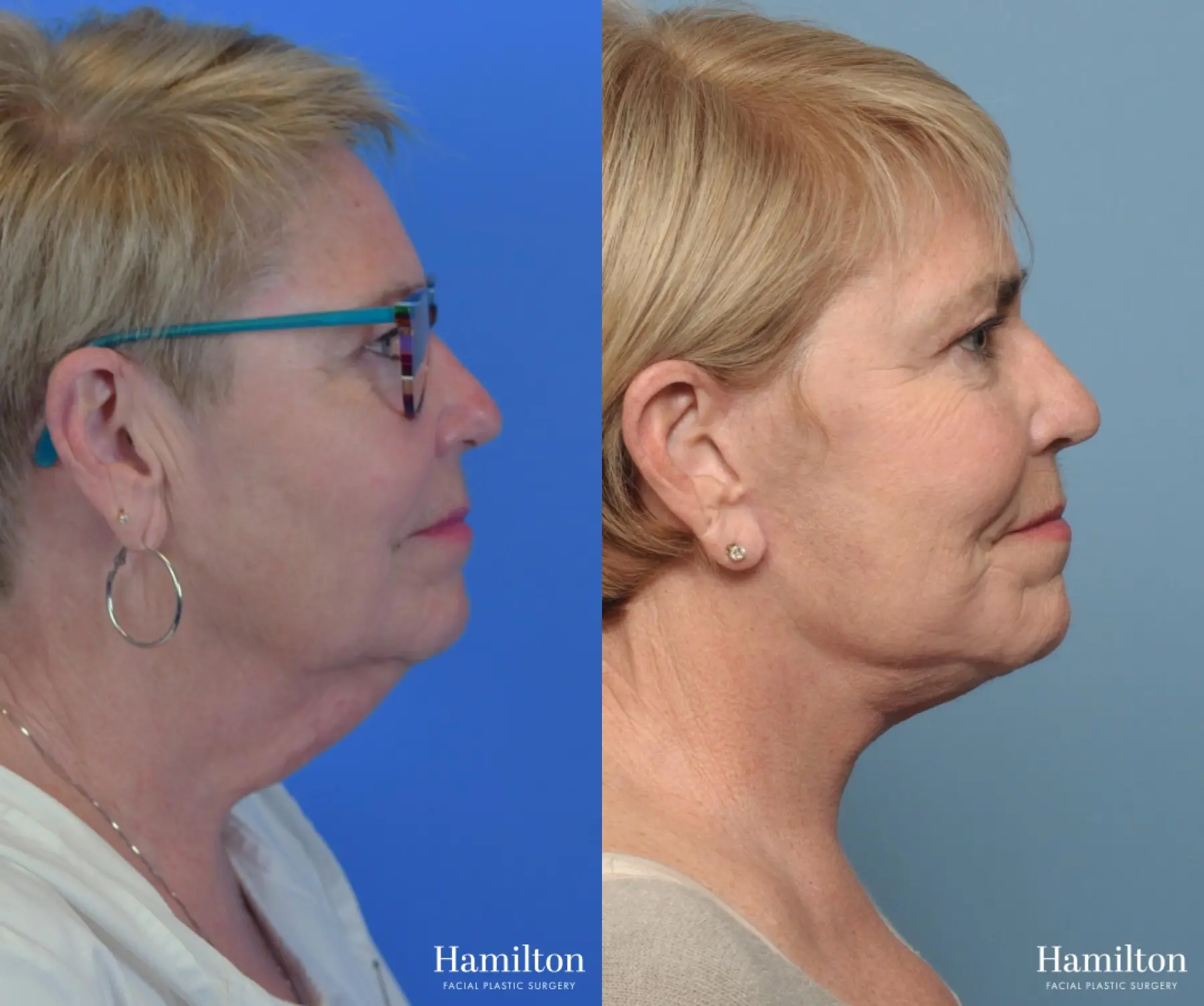 Facelift: Patient 18 - Before and After 2