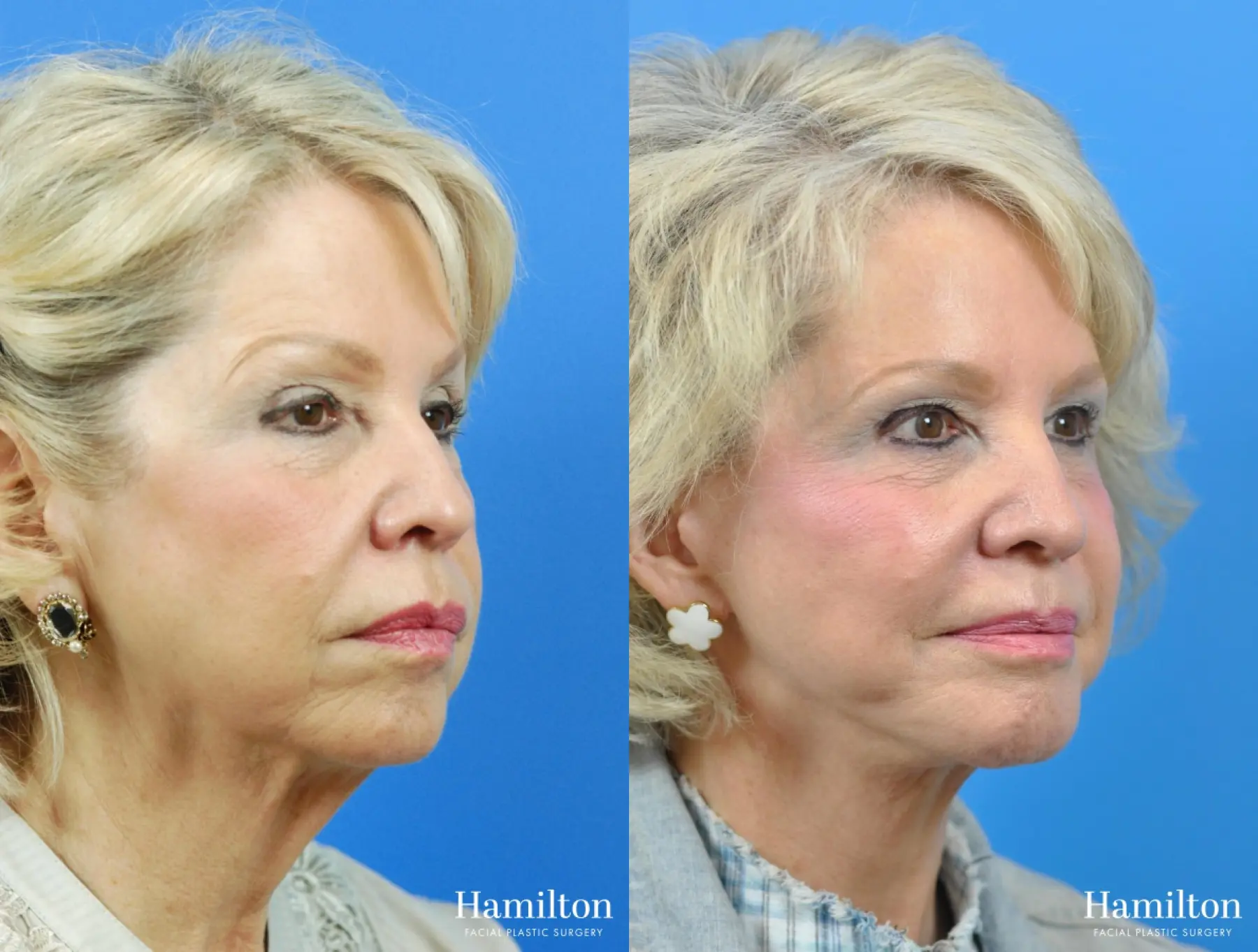 Facelift: Patient 20 - Before and After 2