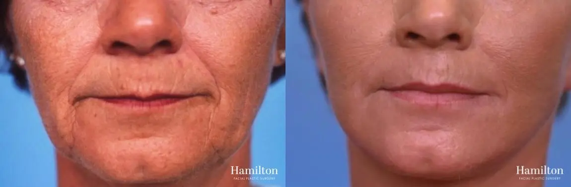 Facelift: Patient 40 - Before and After 5