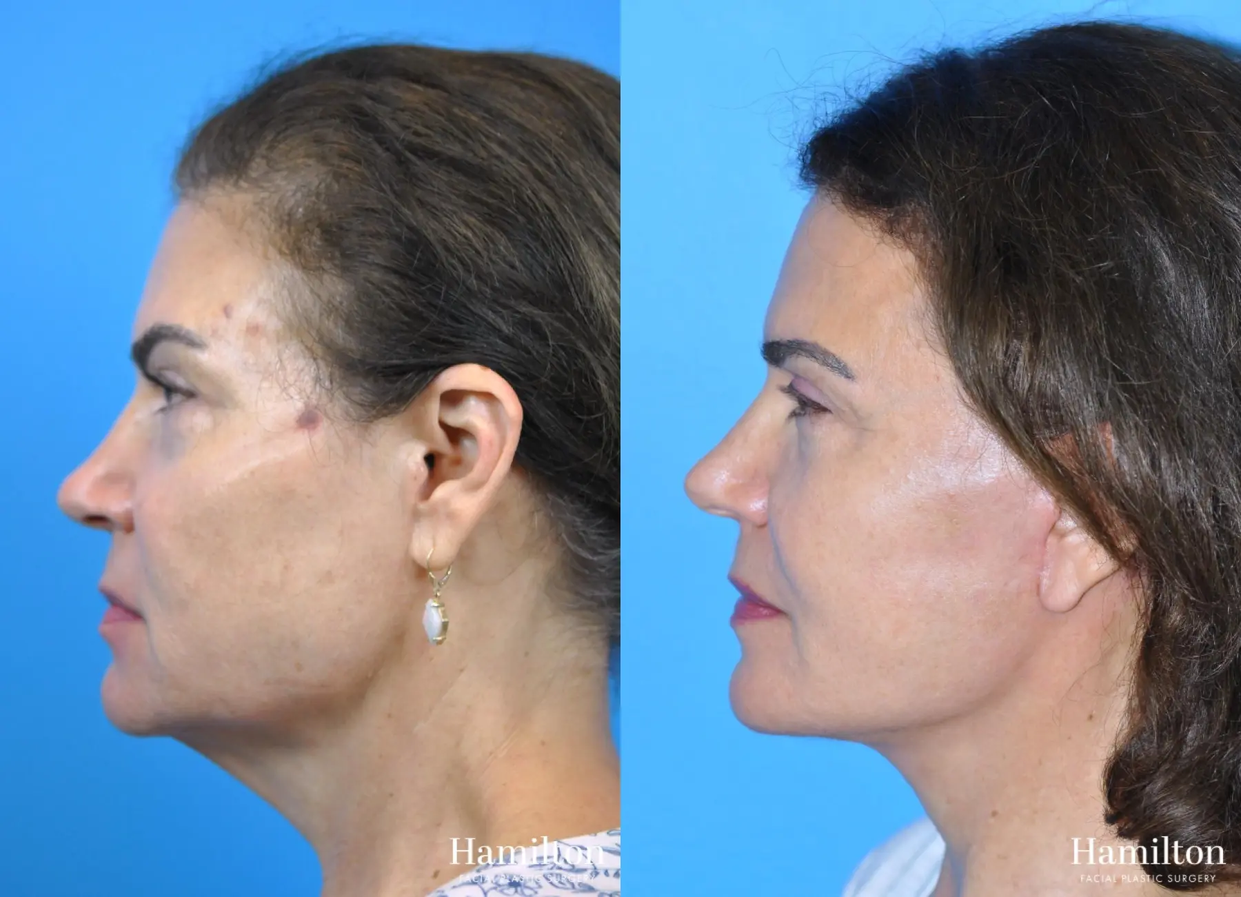 Facelift: Patient 13 - Before and After 1