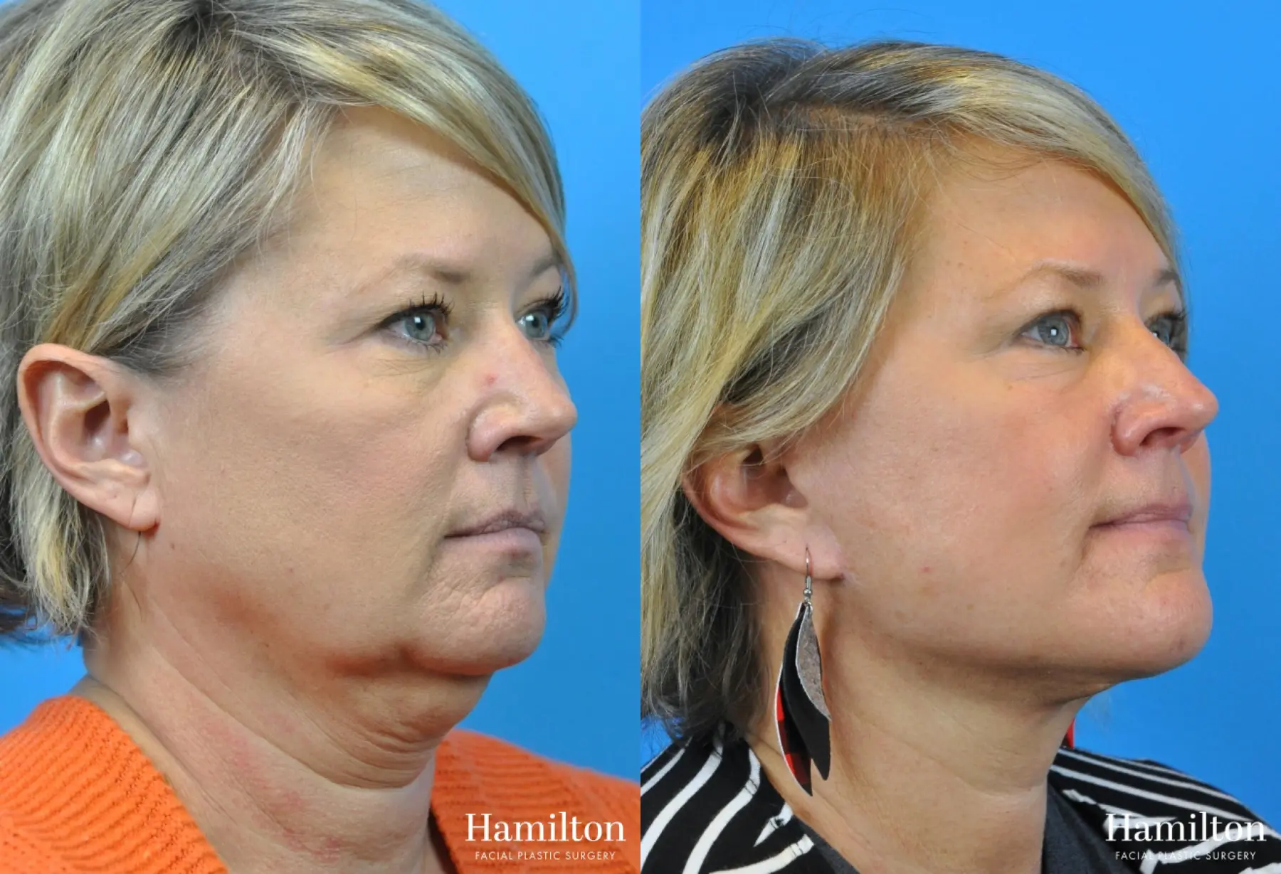 Facelift: Patient 7 - Before and After 4