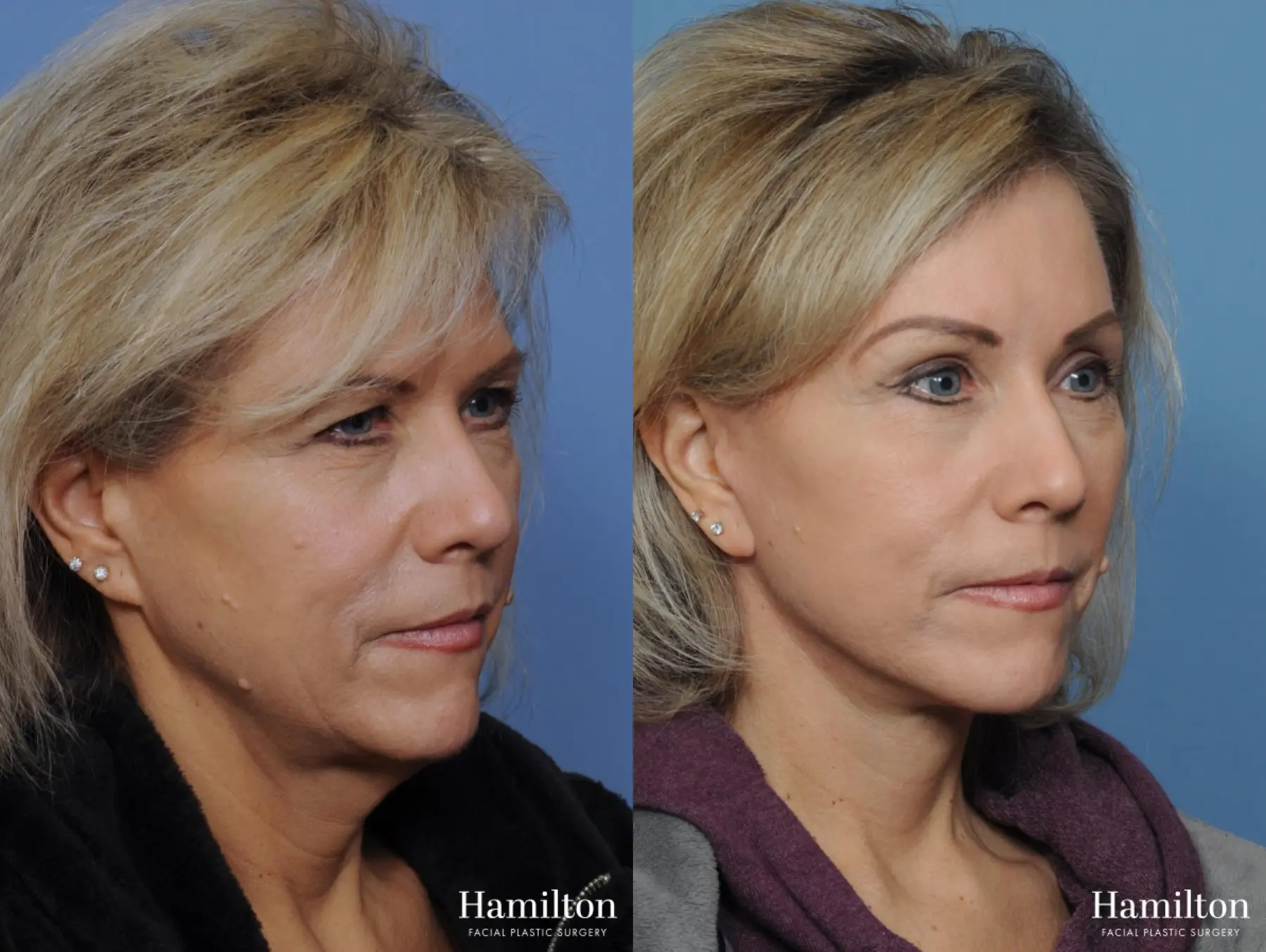 Facelift: Patient 3 - Before and After 4