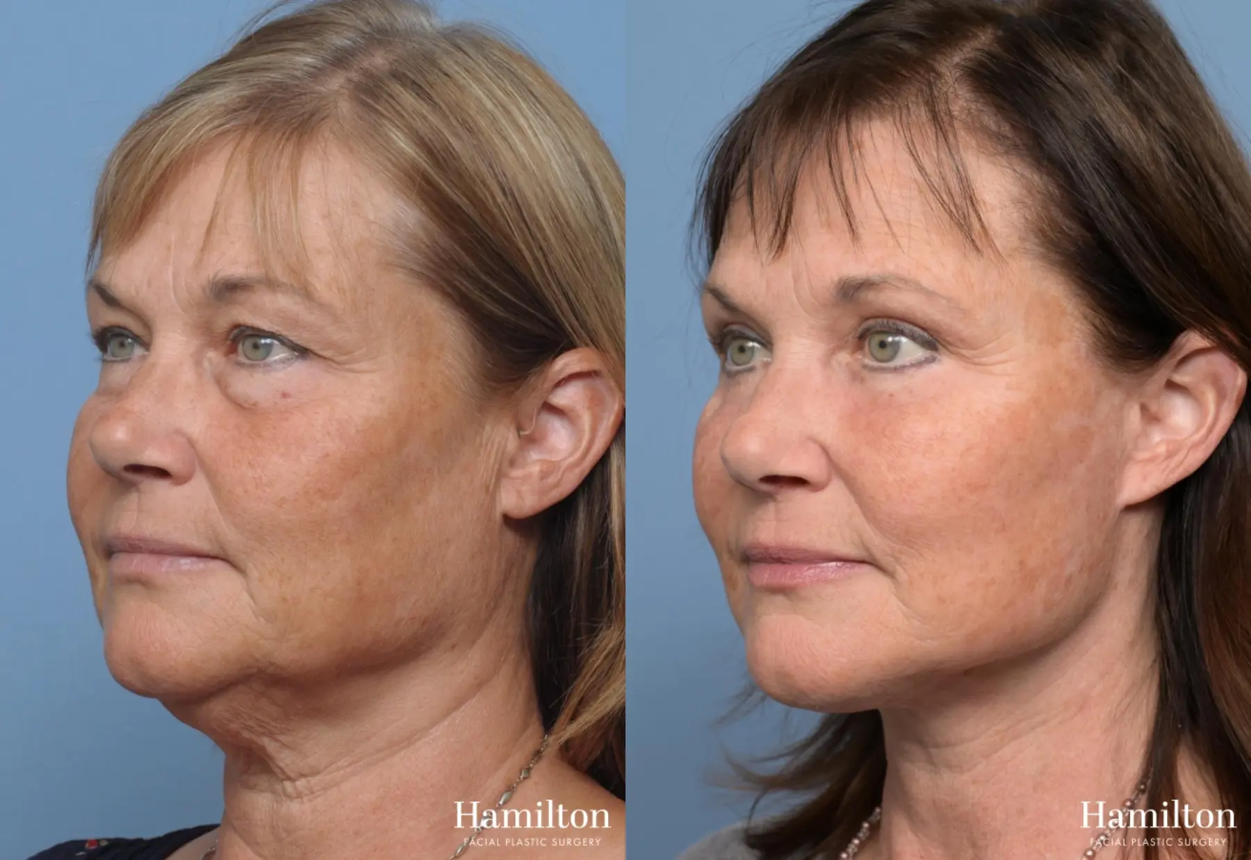 Facelift: Patient 14 - Before and After 2