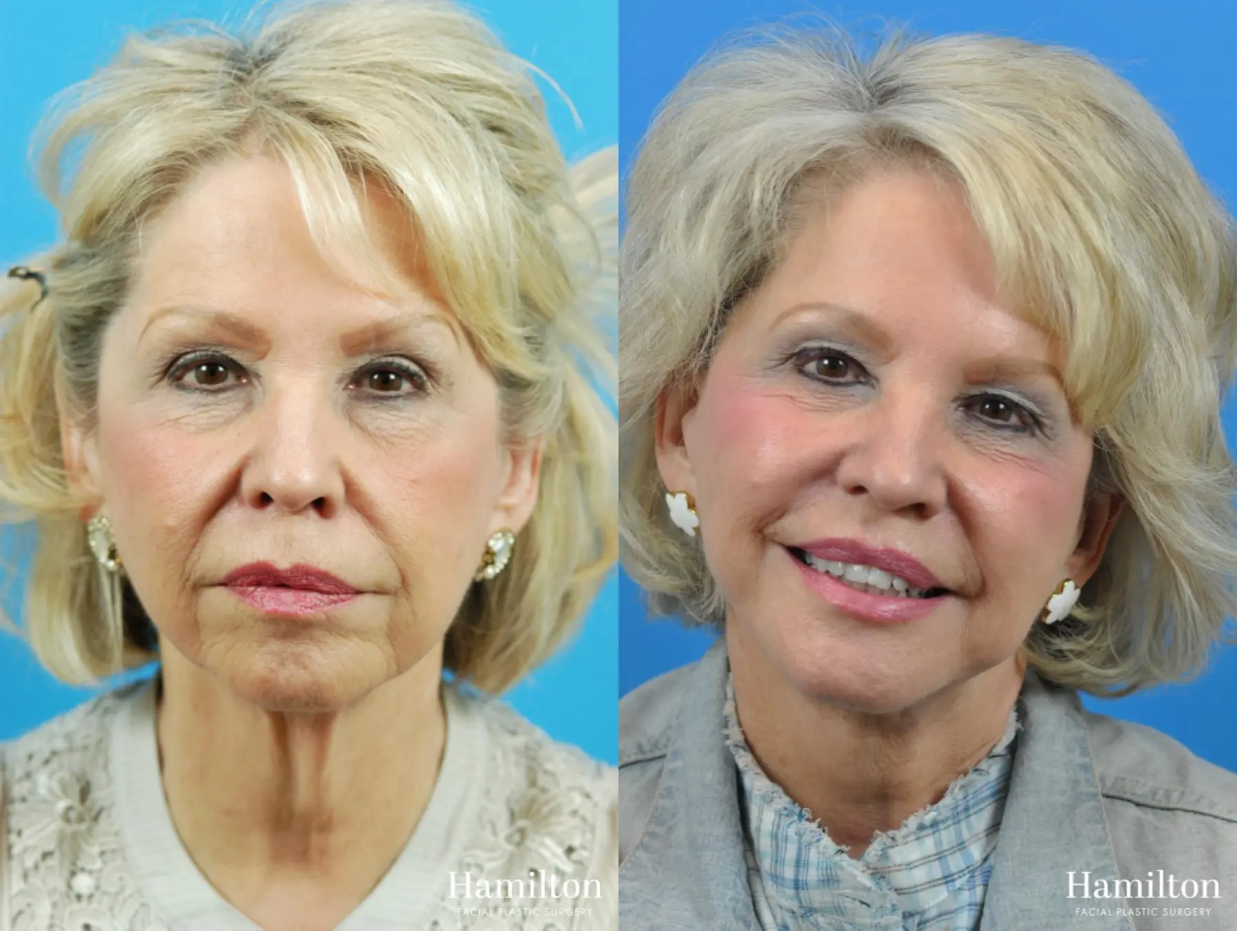 Facelift: Patient 20 - Before and After 5
