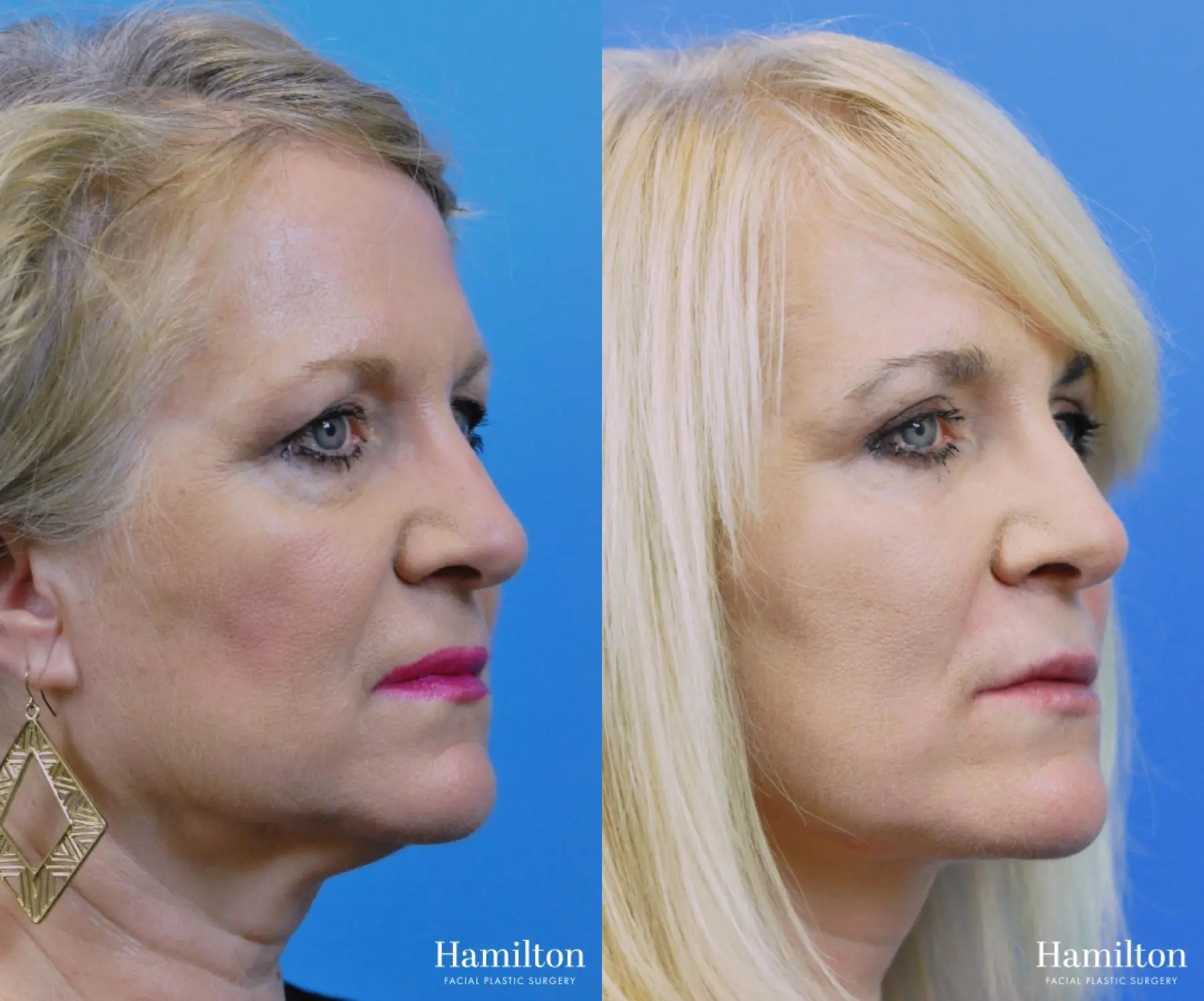 Facelift: Patient 10 - Before and After 1